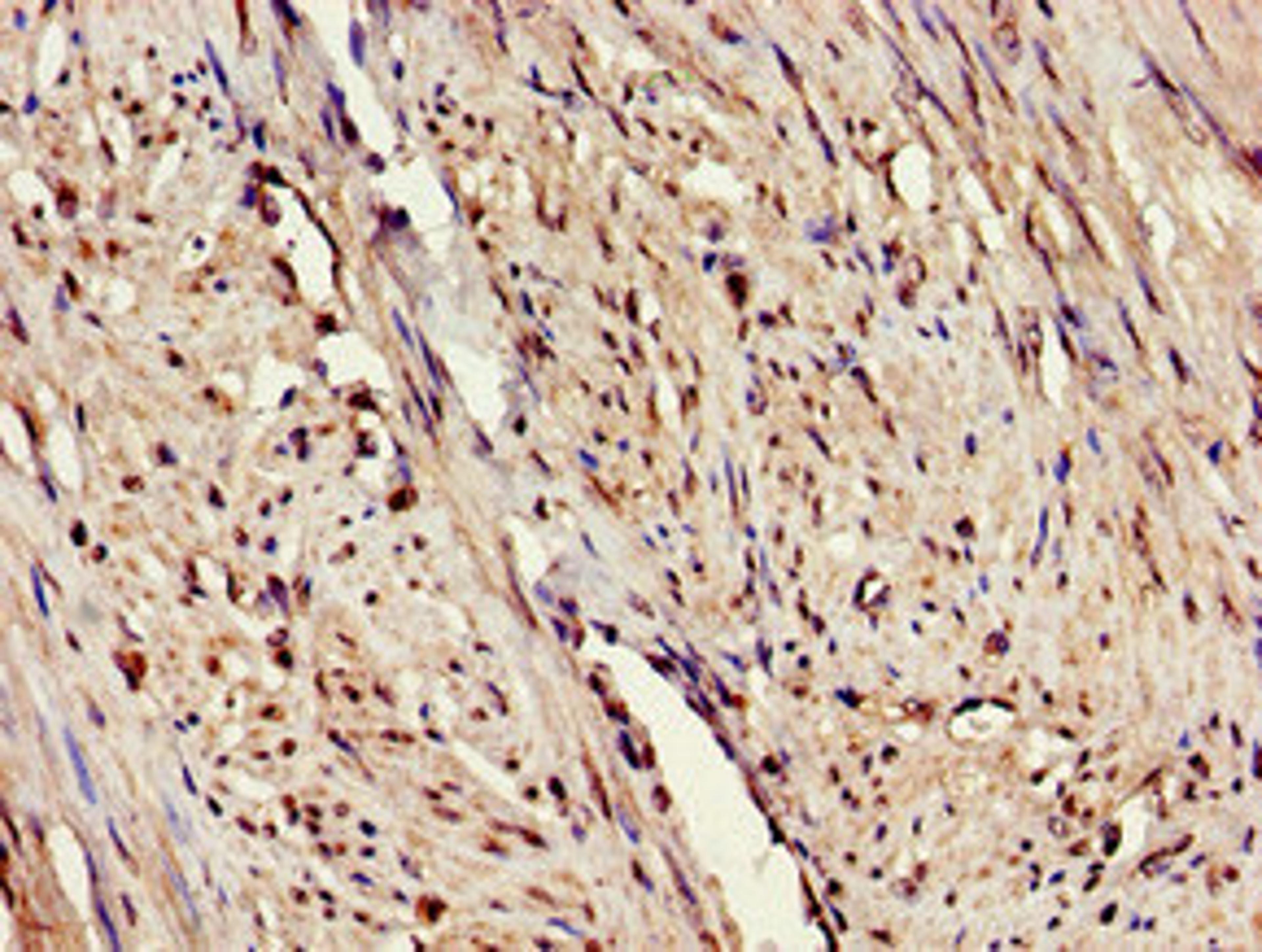 Immunohistochemistry of paraffin-embedded human endometrial cancer using CSB-PA007760LA01HU at dilution of 1:100