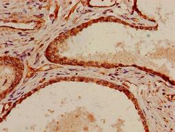 Immunohistochemistry of paraffin-embedded human prostate cancer using CSB-PA021253LA01HU at dilution of 1:100
