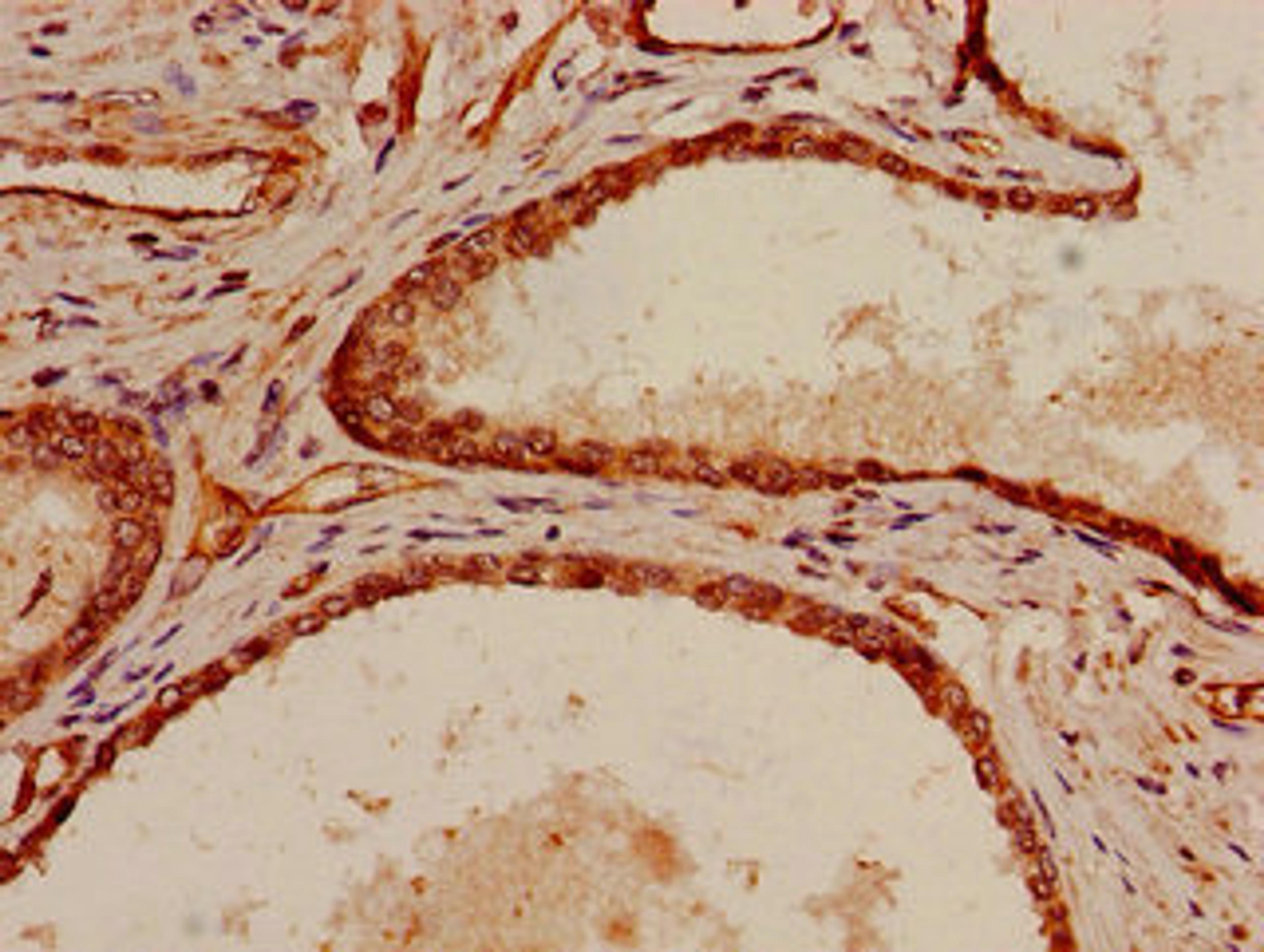Immunohistochemistry of paraffin-embedded human prostate cancer using CSB-PA021253LA01HU at dilution of 1:100