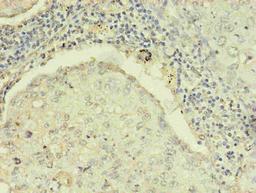 Immunohistochemistry of paraffin-embedded human lung cancer using CSB-MA0205181A0m in 30ug/ml dilute concentrations.