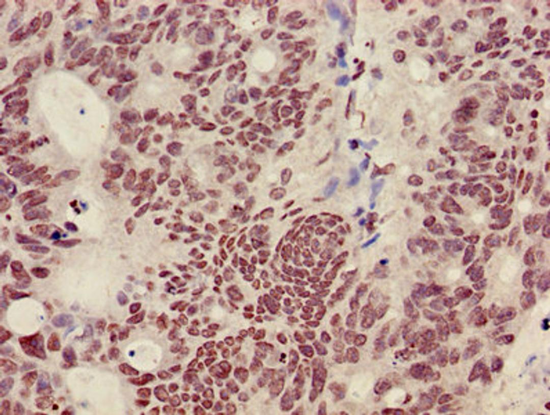 Immunohistochemistry of paraffin-embedded human colon cancer using CSB-PA010418OA36nme2HU at dilution of 1:100