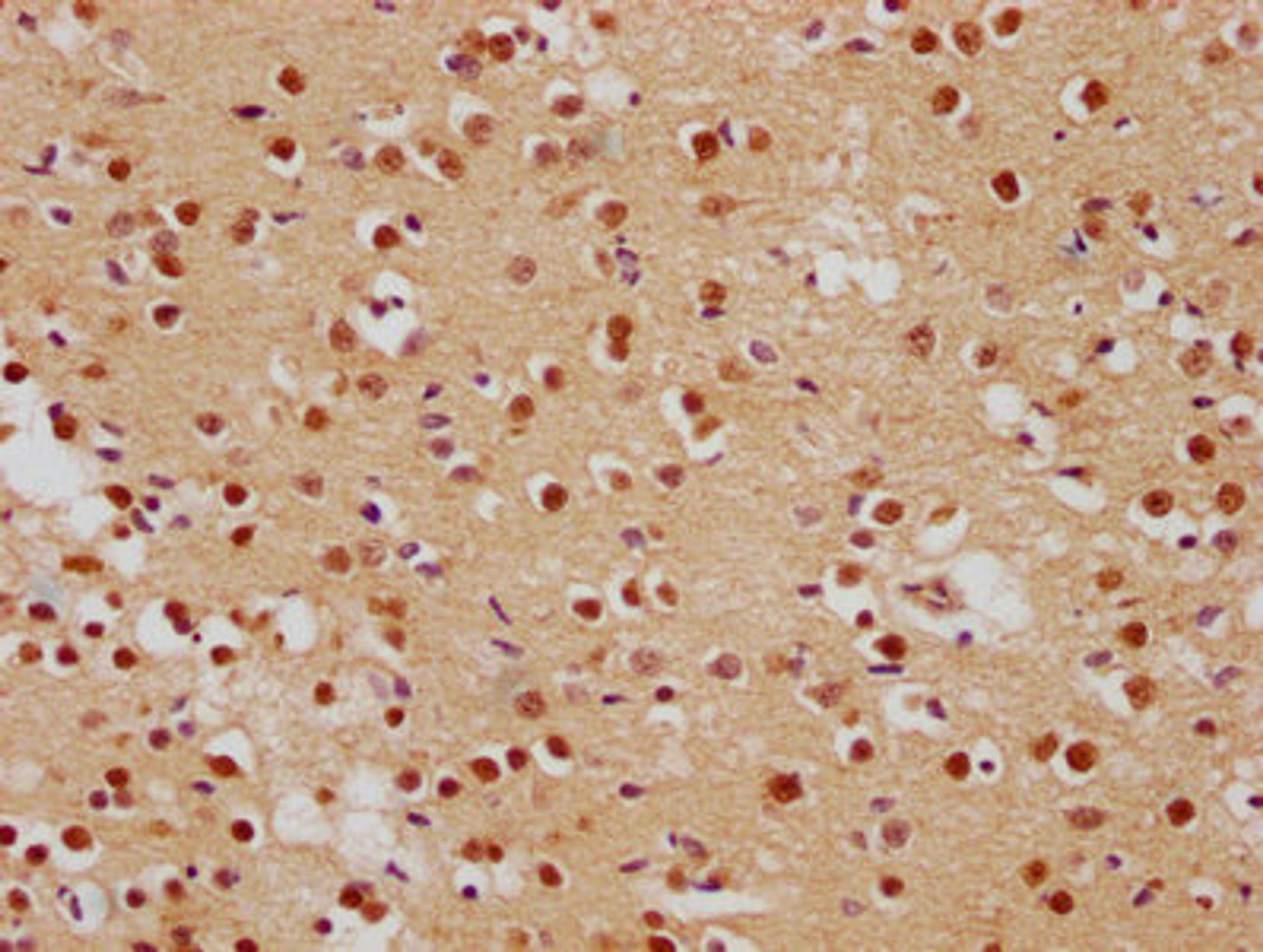 IHC image of CSB-PA008840OA01HU diluted at 1:500 and staining in paraffin-embedded human brain tissue performed on a Leica BondTM system. After dewaxing and hydration, antigen retrieval was mediated by high pressure in a citrate buffer (pH 6.0). Section was blocked with 10% normal goat serum 30min at RT. Then primary antibody (1% BSA) was incubated at 4°C overnight. The primary is detected by a biotinylated secondary antibody and visualized using an HRP conjugated SP system.