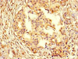 Immunohistochemistry of paraffin-embedded human pancreatic cancer using CSB-PA01567A0Rb at dilution of 1:100