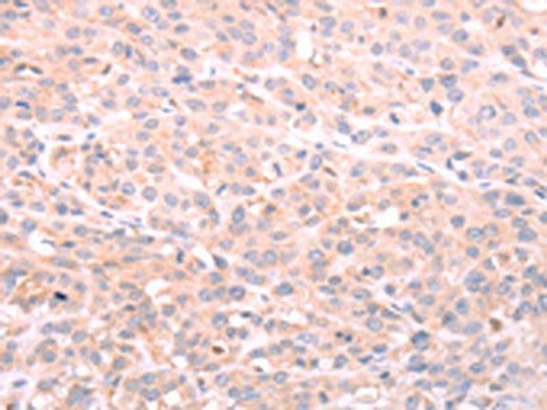 The image on the left is immunohistochemistry of paraffin-embedded Human esophagus cancer tissue using CSB-PA953030(NFKBIE Antibody) at dilution 1/40, on the right is treated with fusion protein. (Original magnification: ×200)