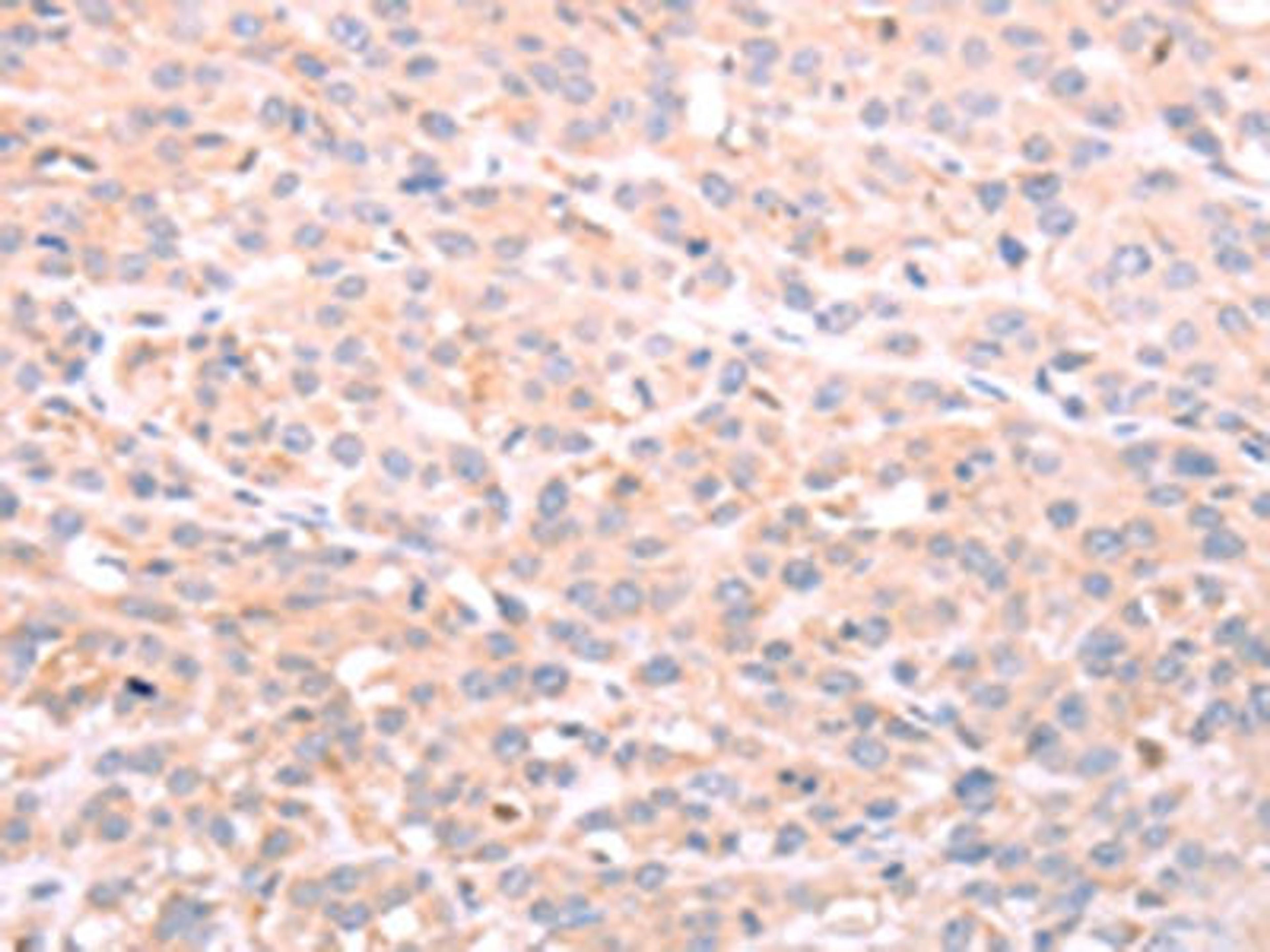 The image on the left is immunohistochemistry of paraffin-embedded Human esophagus cancer tissue using CSB-PA953030(NFKBIE Antibody) at dilution 1/40, on the right is treated with fusion protein. (Original magnification: ×200)