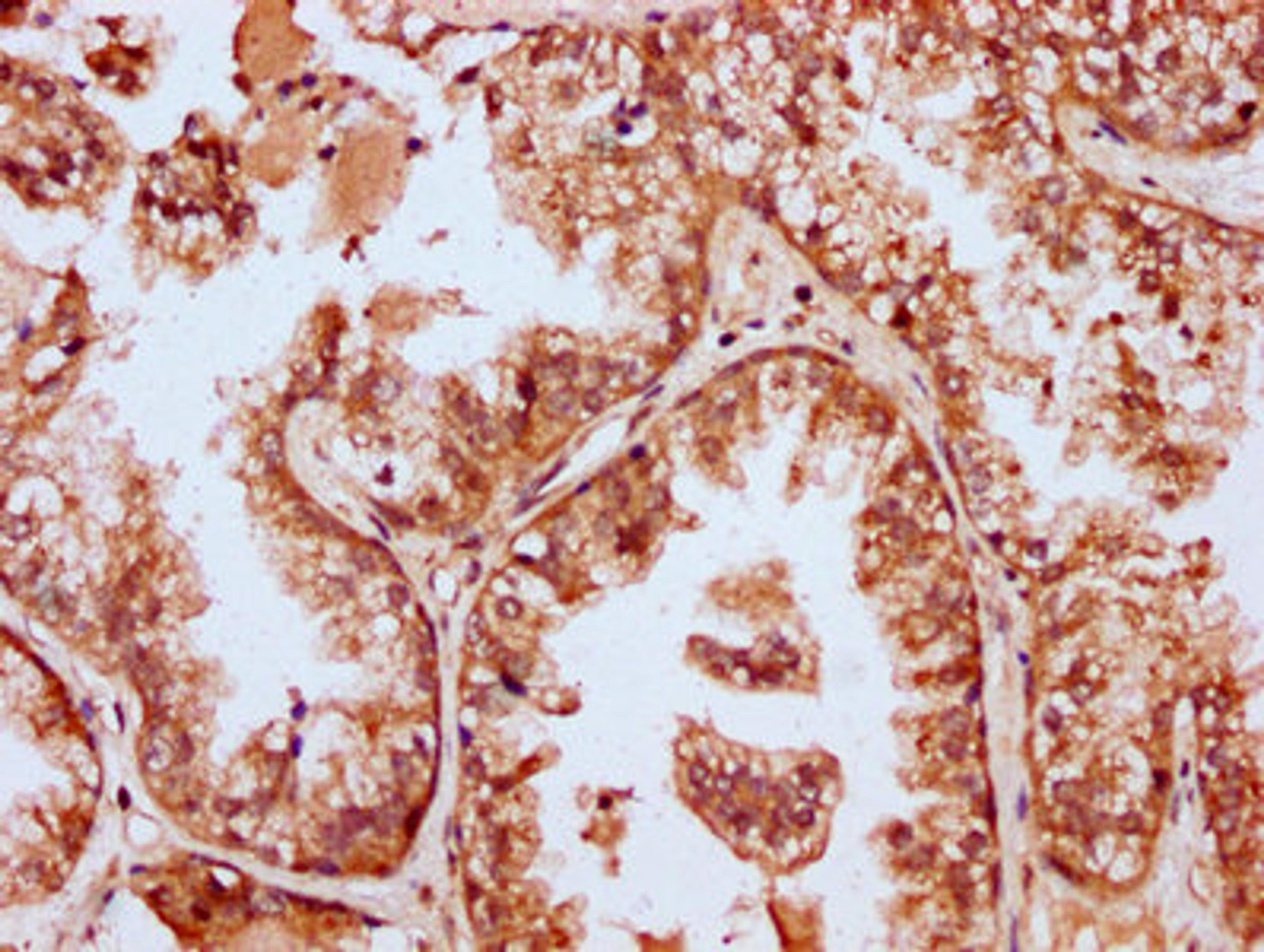 IHC image of CSB-PA868322LA01HU diluted at 1:400 and staining in paraffin-embedded human prostate cancer performed on a Leica BondTM system. After dewaxing and hydration, antigen retrieval was mediated by high pressure in a citrate buffer (pH 6.0). Section was blocked with 10% normal goat serum 30min at RT. Then primary antibody (1% BSA) was incubated at 4°C overnight. The primary is detected by a biotinylated secondary antibody and visualized using an HRP conjugated SP system.