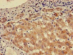 Immunohistochemistry of paraffin-embedded human liver cancer using CSB-PA848409LA01HU at dilution of 1:100