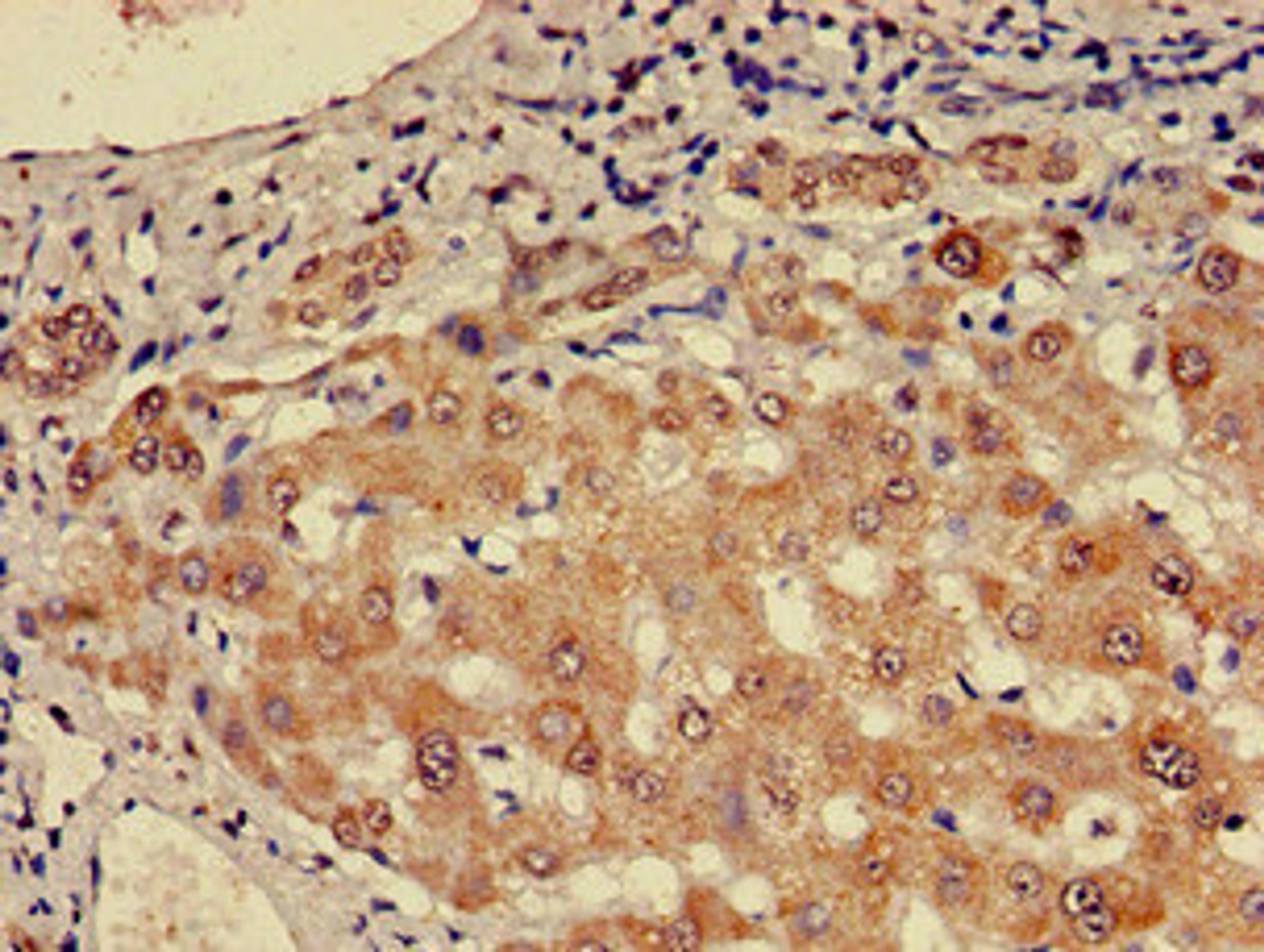 Immunohistochemistry of paraffin-embedded human liver cancer using CSB-PA848409LA01HU at dilution of 1:100