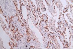 IHC image of CSB-RA548145A0HU diluted at 1:50 and staining in paraffin-embedded human lung cancer performed on a Leica BondTM system. After dewaxing and hydration, antigen retrieval was mediated by high pressure in a citrate buffer (pH 6.0). Section was blocked with 10% normal goat serum 30min at RT. Then primary antibody (1% BSA) was incubated at 4°C overnight. The primary is detected by a Goat anti-rabbit polymer IgG labeled by HRP and visualized using 0.33% DAB.