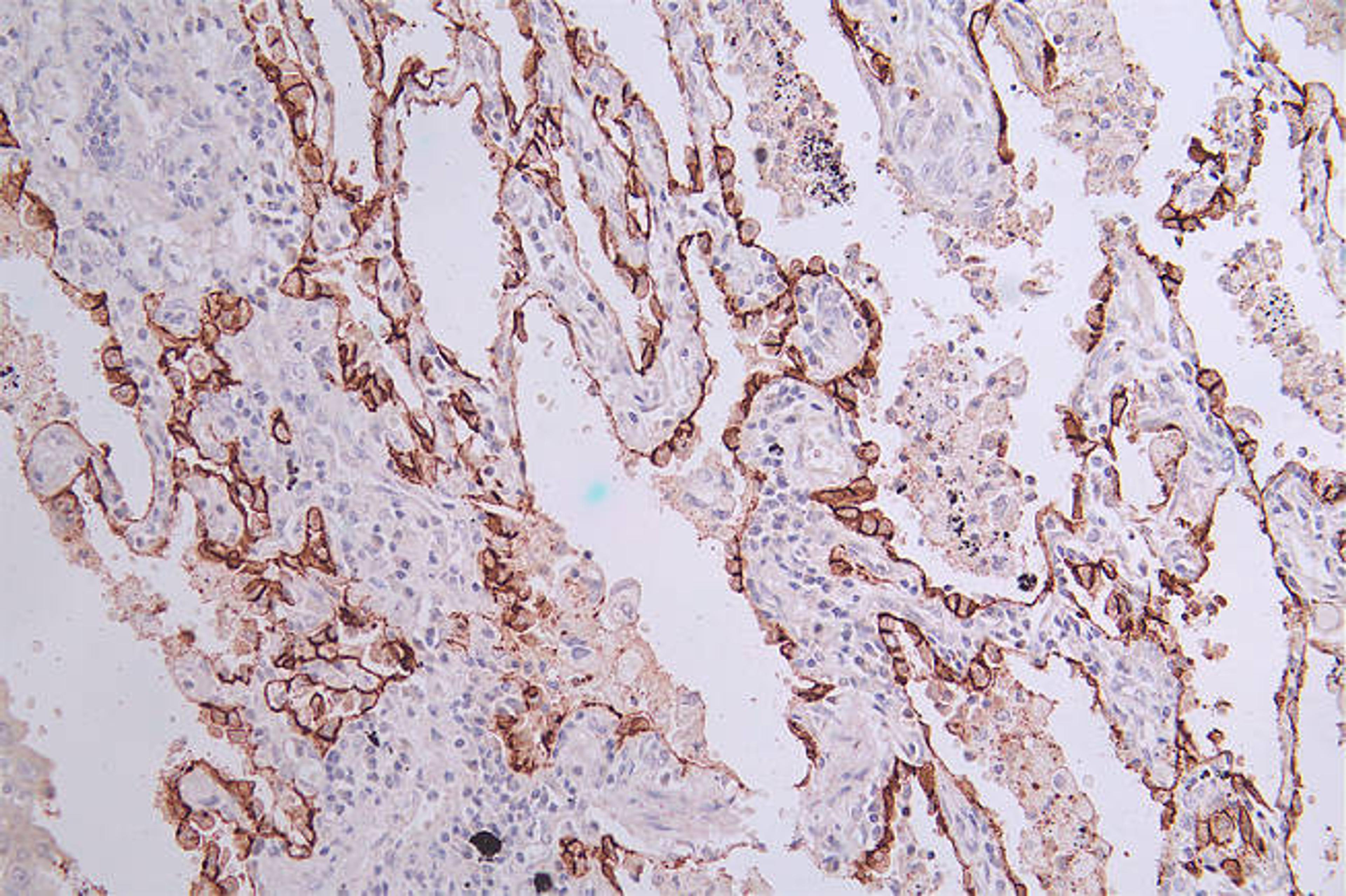 IHC image of CSB-RA548145A0HU diluted at 1:50 and staining in paraffin-embedded human lung cancer performed on a Leica BondTM system. After dewaxing and hydration, antigen retrieval was mediated by high pressure in a citrate buffer (pH 6.0). Section was blocked with 10% normal goat serum 30min at RT. Then primary antibody (1% BSA) was incubated at 4°C overnight. The primary is detected by a Goat anti-rabbit polymer IgG labeled by HRP and visualized using 0.33% DAB.