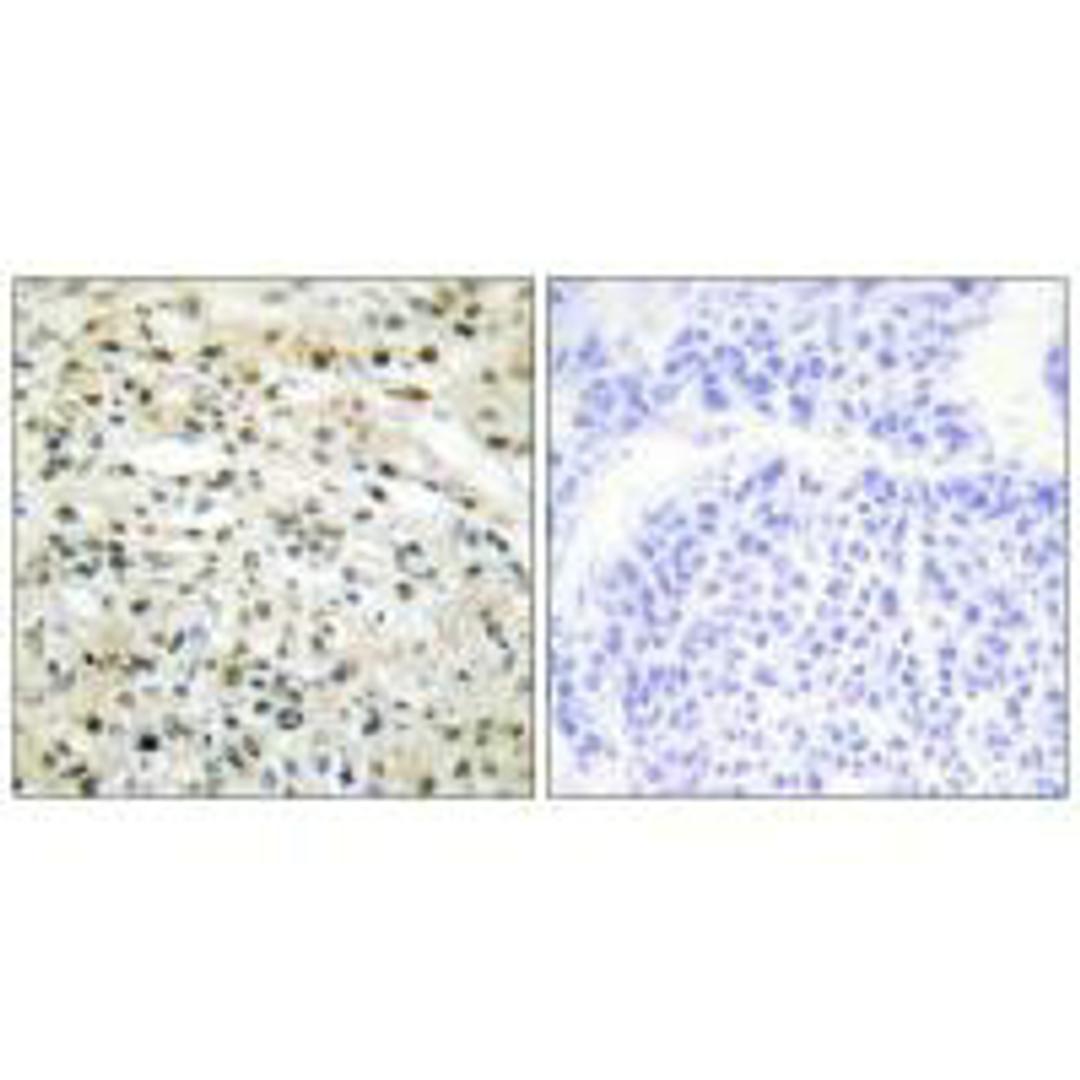 Immunohistochemistry analysis of paraffin-embedded human liver carcinoma tissue using DNMT3B antibody.