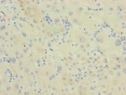 Immunohistochemistry of paraffin-embedded human liver cancer using CSB-PA819454LA01HU at dilution of 1:100