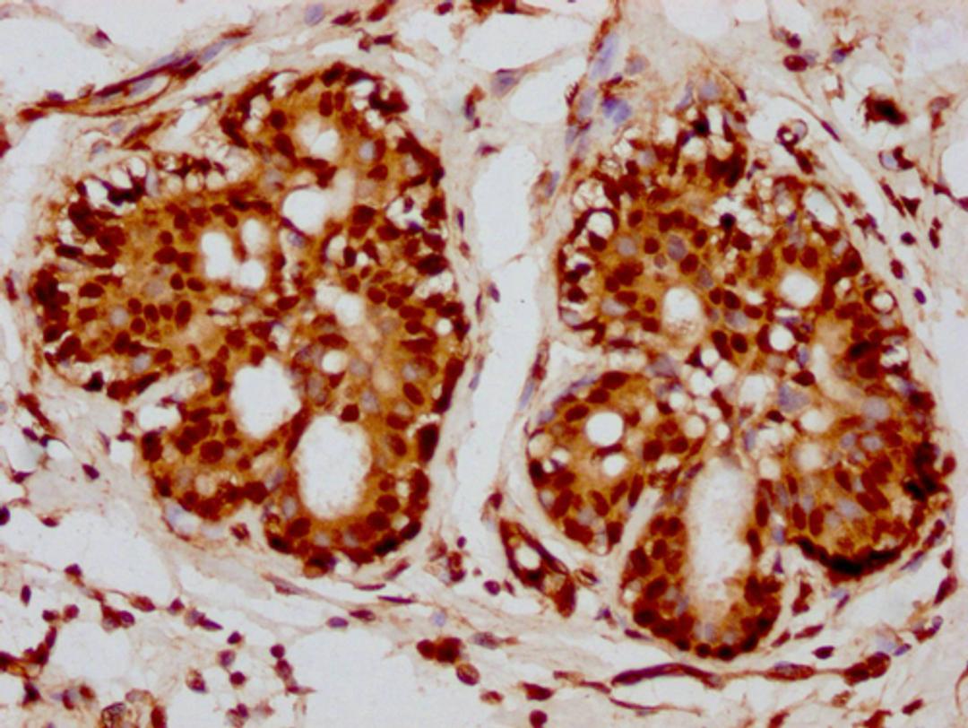 IHC image of CSB-PA010418PA115nacHU diluted at 1:10 and staining in paraffin-embedded human breast cancer performed on a Leica BondTM system. After dewaxing and hydration, antigen retrieval was mediated by high pressure in a citrate buffer (pH 6.0). Section was blocked with 10% normal goat serum 30min at RT. Then primary antibody (1% BSA) was incubated at 4°C overnight. The primary is detected by a biotinylated secondary antibody and visualized using an HRP conjugated SP system.