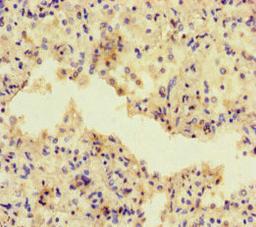 Immunohistochemistry of paraffin-embedded human lung cancer using CSB-PA600142LA01HU at dilution of 1:100