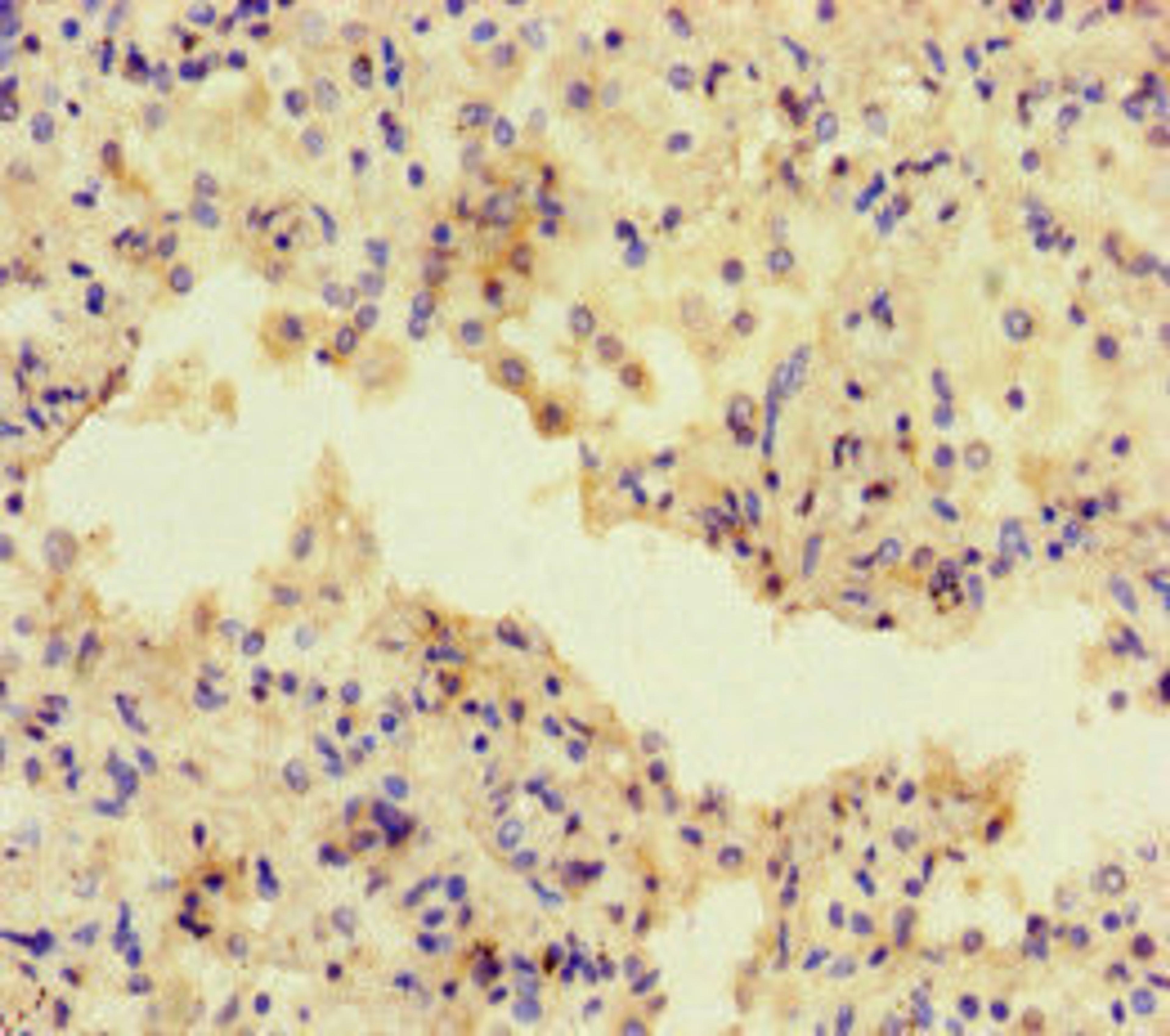 Immunohistochemistry of paraffin-embedded human lung cancer using CSB-PA600142LA01HU at dilution of 1:100