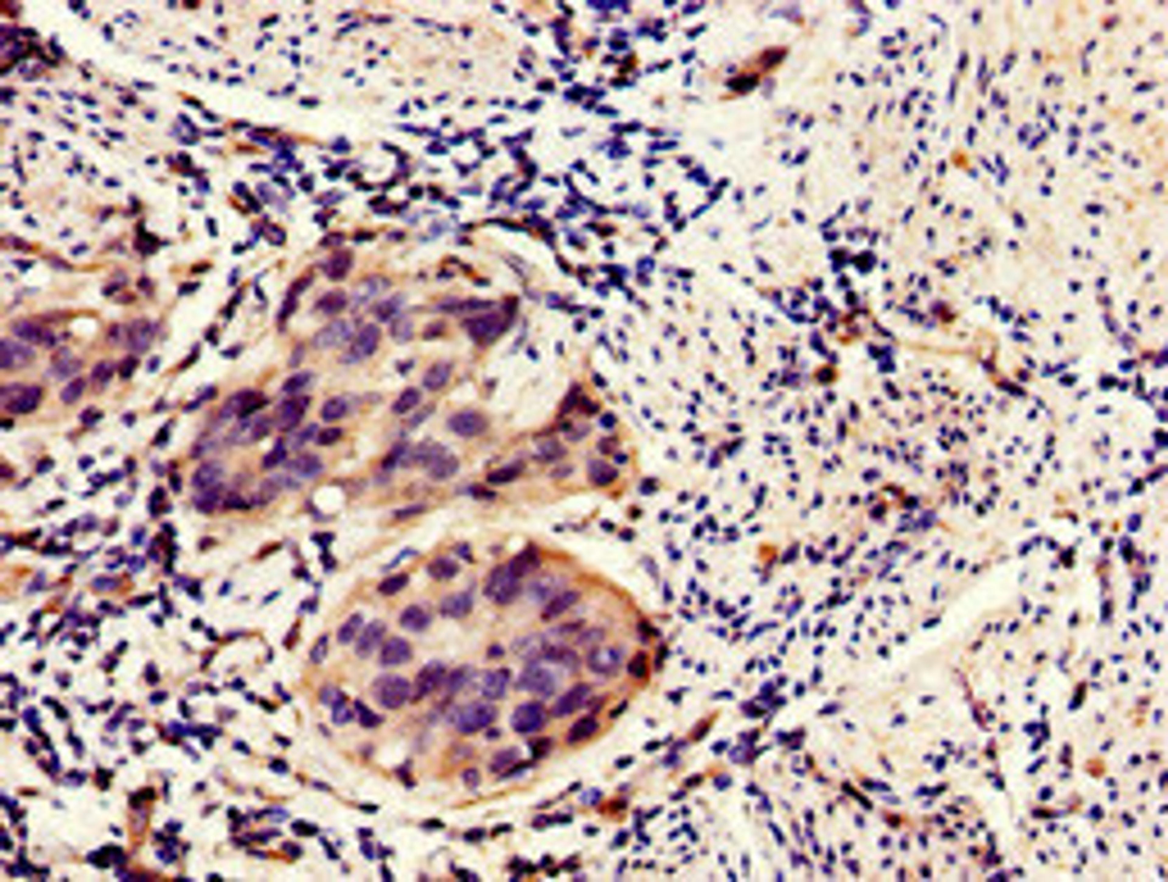 Immunohistochemistry of paraffin-embedded human bladder cancer using CSB-PA872492LA01HU at dilution of 1:100