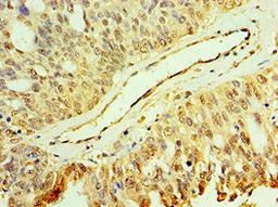 Immunohistochemistry of paraffin-embedded human endometrial cancer using CSB-PA013412ESR1HU at dilution of 1:100