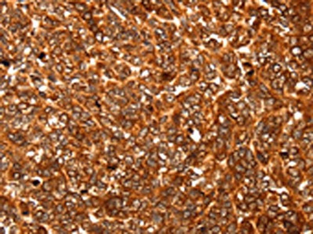 The image on the left is immunohistochemistry of paraffin-embedded Human ovarian cancer tissue using CSB-PA955823(ALDOA Antibody) at dilution 1/30, on the right is treated with fusion protein. (Original magnification: ×200)