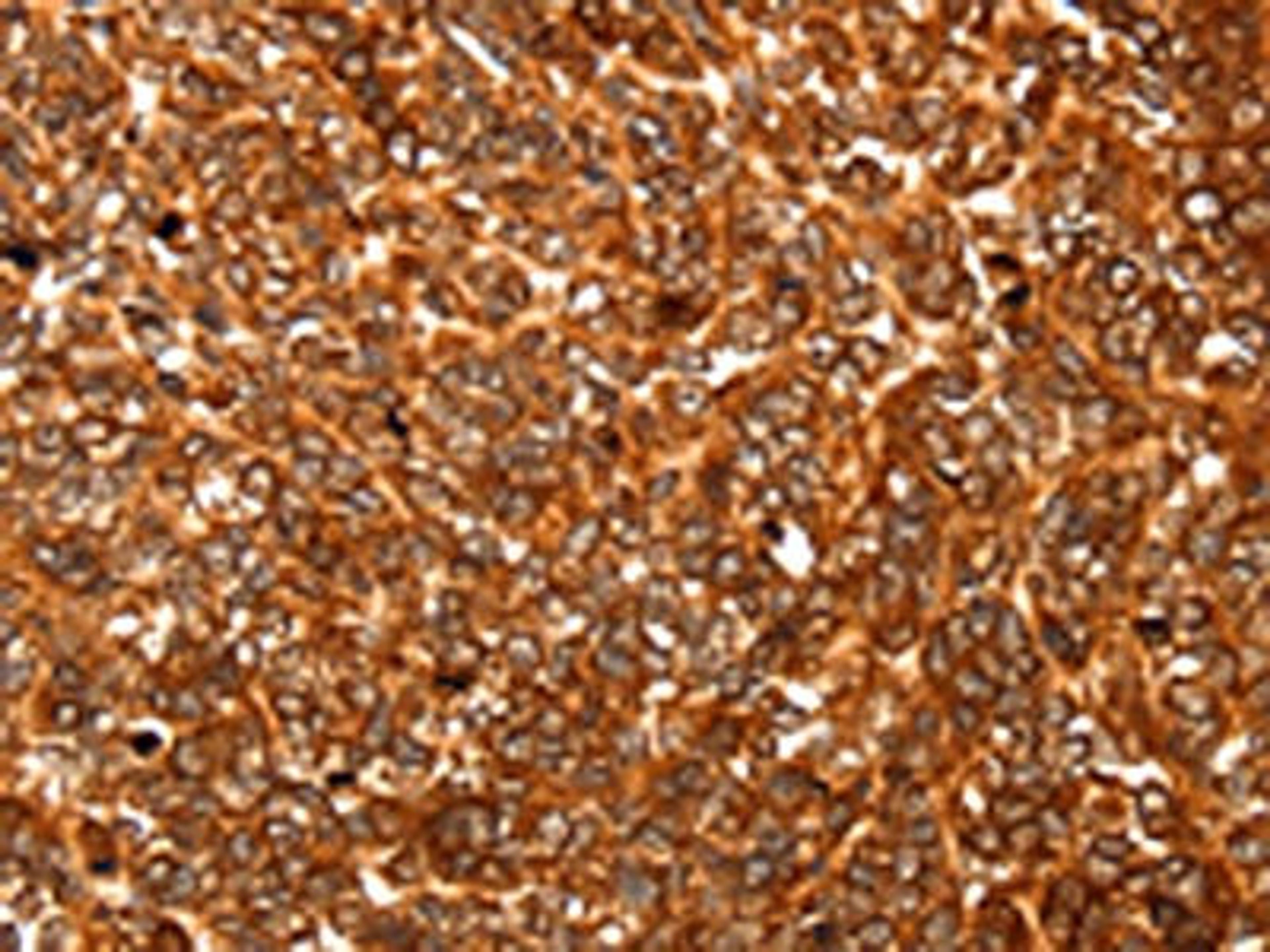 The image on the left is immunohistochemistry of paraffin-embedded Human ovarian cancer tissue using CSB-PA955823(ALDOA Antibody) at dilution 1/30, on the right is treated with fusion protein. (Original magnification: ×200)