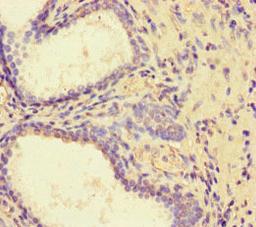 Immunohistochemistry of paraffin-embedded human prostate cancer using CSB-PA822223LA01HU at dilution of 1:100