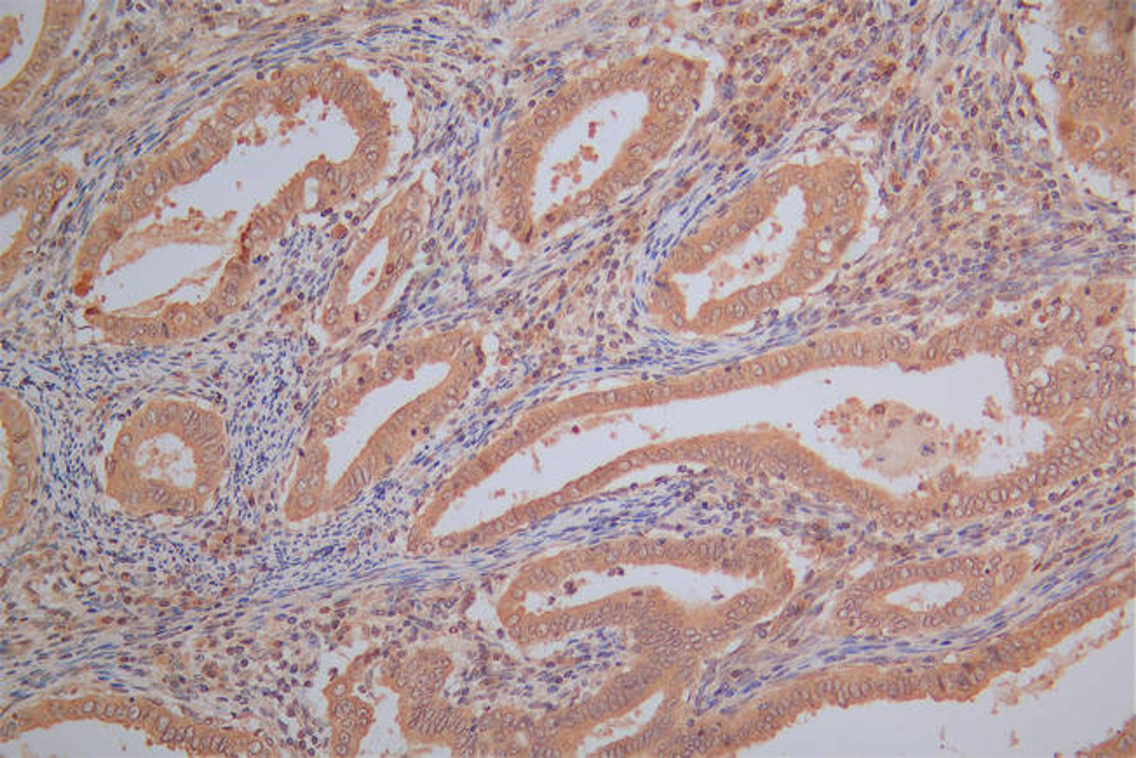 IHC image of CSB-RA339235MA1HU diluted at 1:130 and staining in paraffin-embedded human endometrial cancer performed on a Leica BondTM system. After dewaxing and hydration,  antigen retrieval was mediated by high pressure in a citrate buffer (pH 6.0). Section was blocked with 10% normal goat serum 30min at RT. Then primary antibody (1% BSA) was incubated at 4°C overnight. The primary is detected by a Goat anti-Mouse IgG labeled by HRP and visualized using 0.05% DAB.