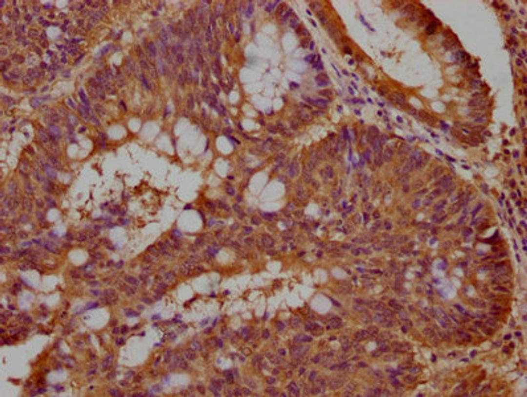 IHC image of CSB-PA850320OA01HU diluted at 1:100 and staining in paraffin-embedded human colon cancer performed on a Leica BondTM system. After dewaxing and hydration, antigen retrieval was mediated by high pressure in a citrate buffer (pH 6.0). Section was blocked with 10% normal goat serum 30min at RT. Then primary antibody (1% BSA) was incubated at 4°C overnight. The primary is detected by a biotinylated secondary antibody and visualized using an HRP conjugated SP system.