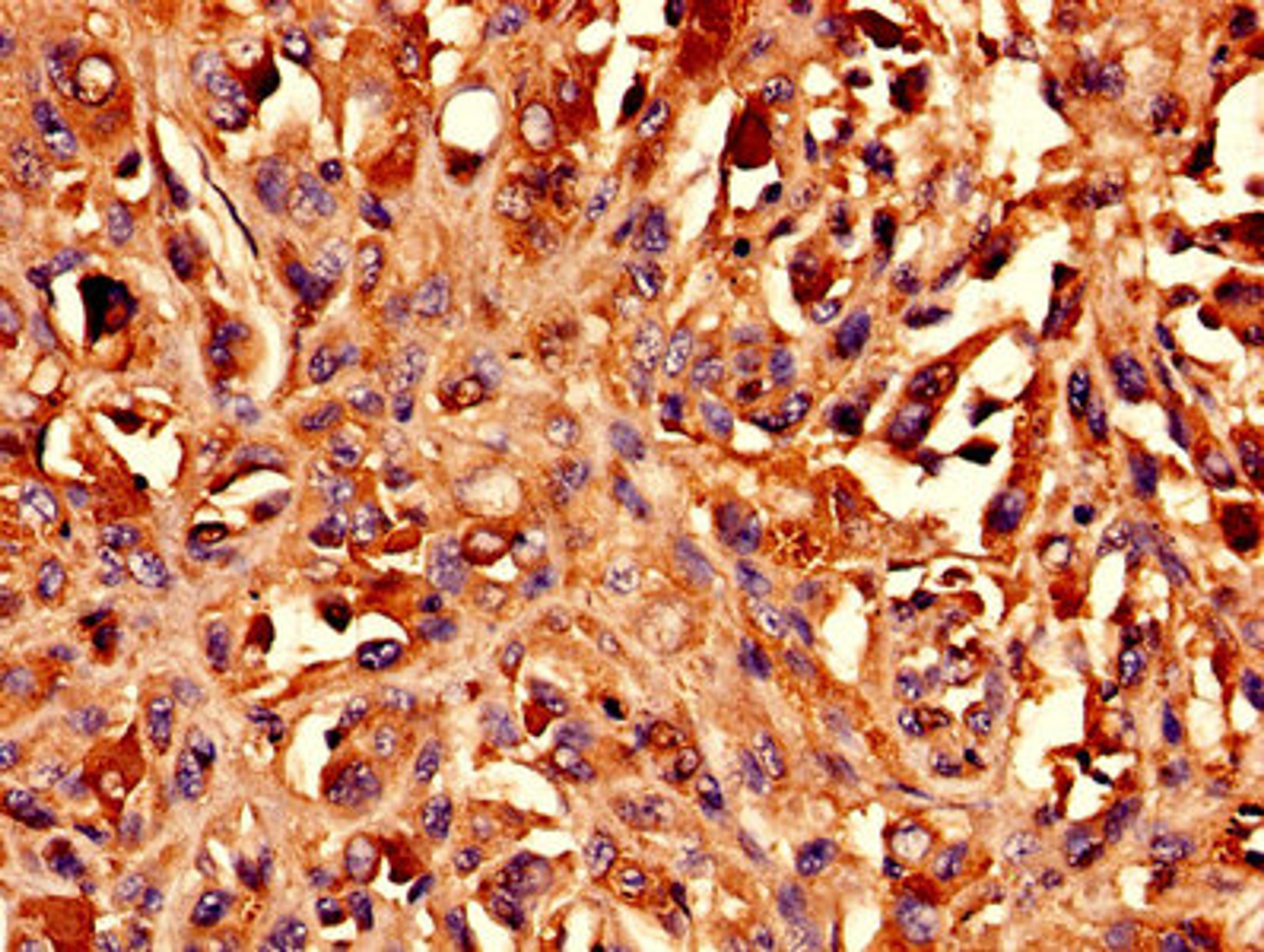 Immunohistochemistry analysis of human melanoma using CSB-PA002600EA01HU at dilution of 1:100