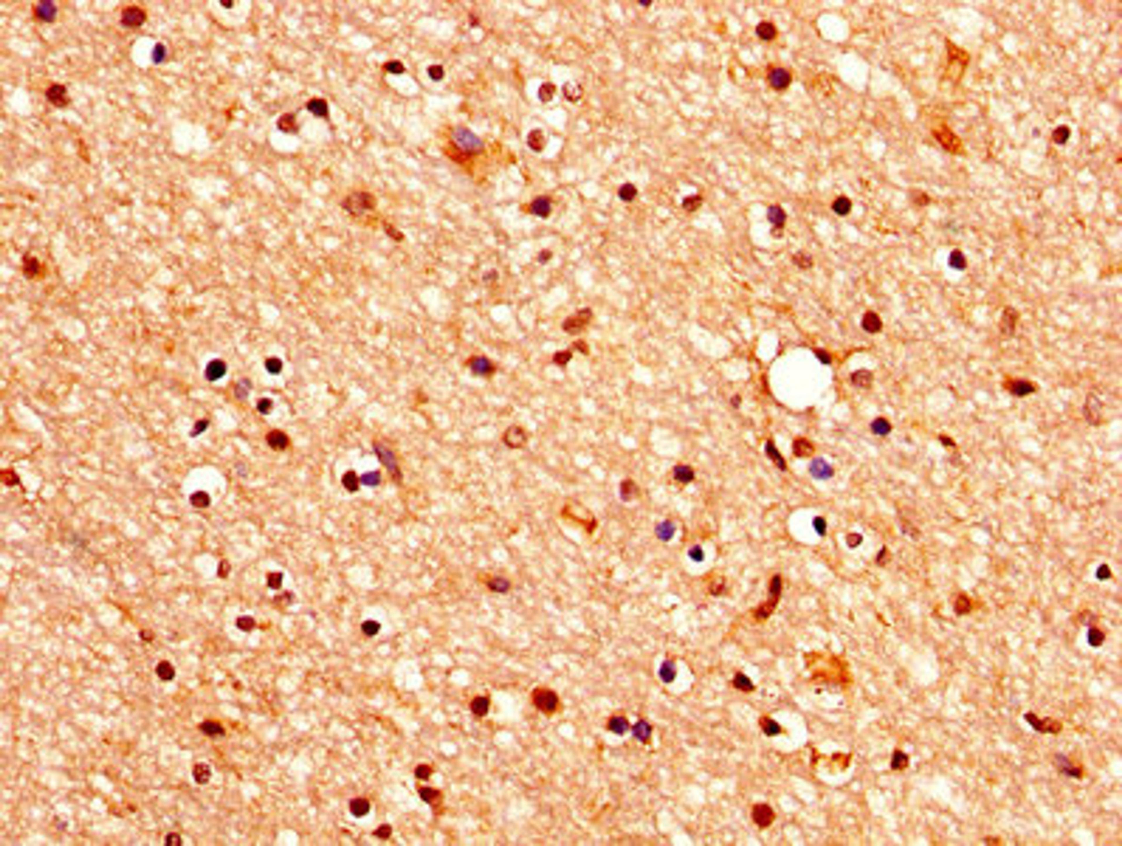 IHC image of CSB-PA005383LA01HU diluted at 1:400 and staining in paraffin-embedded human brain tissue performed on a Leica BondTM system. After dewaxing and hydration, antigen retrieval was mediated by high pressure in a citrate buffer (pH 6.0). Section was blocked with 10% normal goat serum 30min at RT. Then primary antibody (1% BSA) was incubated at 4&deg;C overnight. The primary is detected by a biotinylated secondary antibody and visualized using an HRP conjugated SP system.