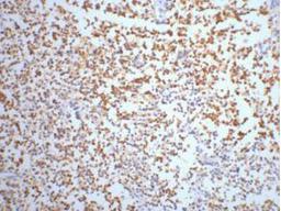 IHC staining of Human small cell carcinoma of lung tissue, diluted at 1:200.
