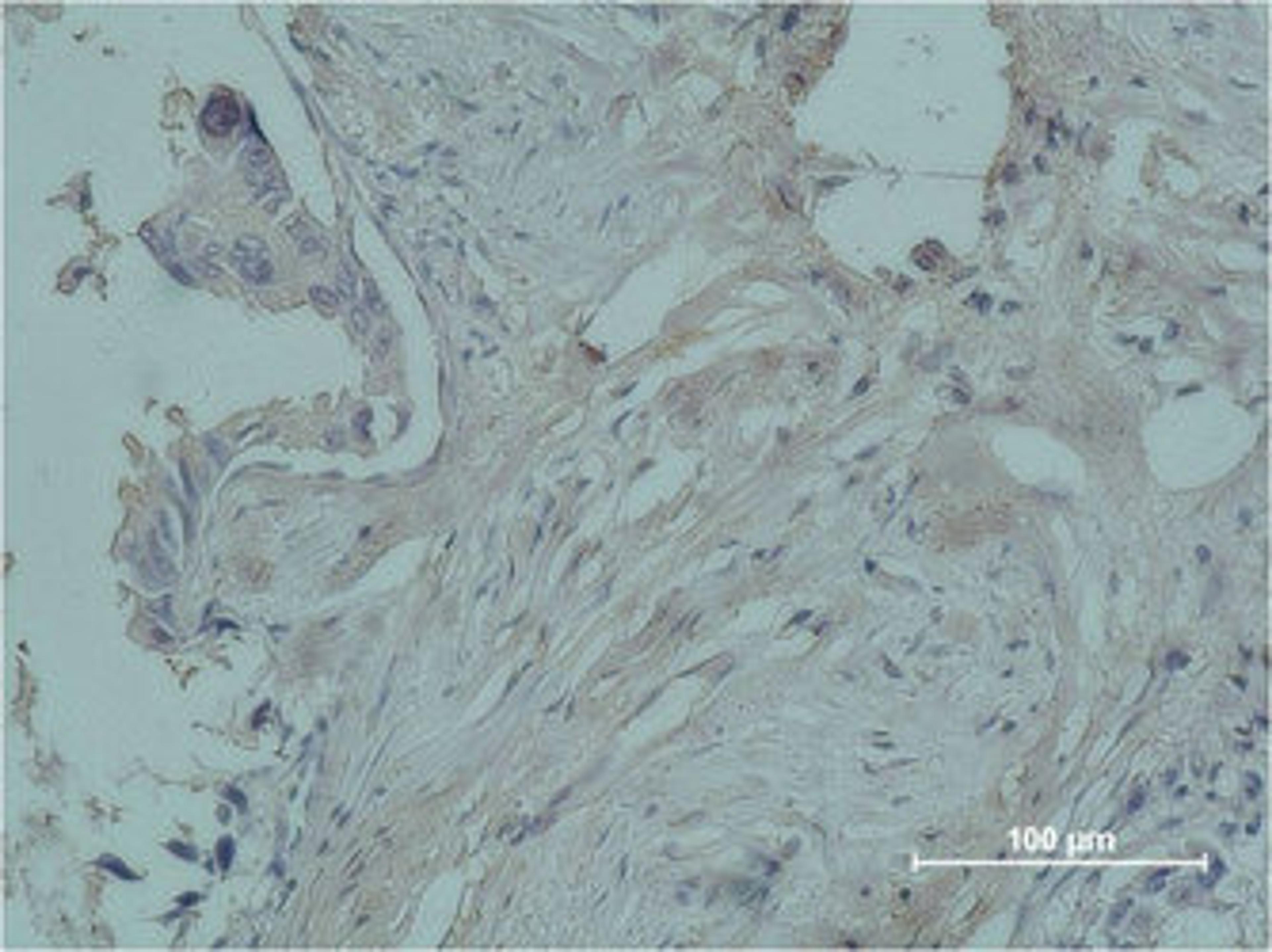 Immunohistochemical analysis of paraffin-embedded human breast caricnoma using PR Monoclonal Antibody.
