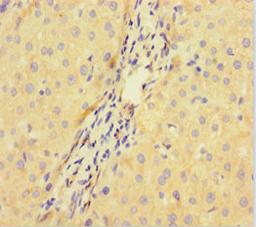 Immunohistochemistry of paraffin-embedded human liver cancer using CSB-PA896722LA01HU at dilution of 1:100