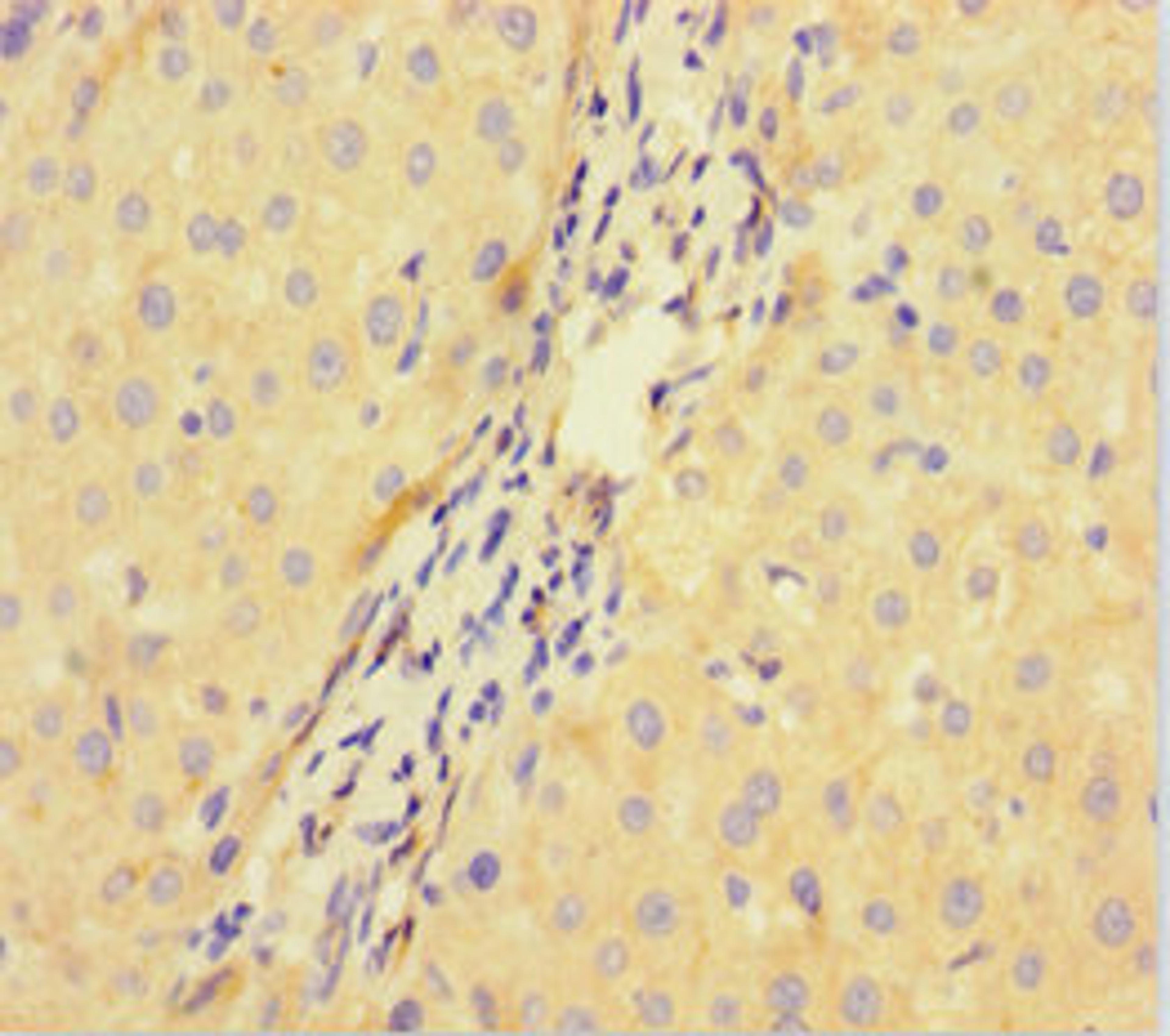 Immunohistochemistry of paraffin-embedded human liver cancer using CSB-PA896722LA01HU at dilution of 1:100