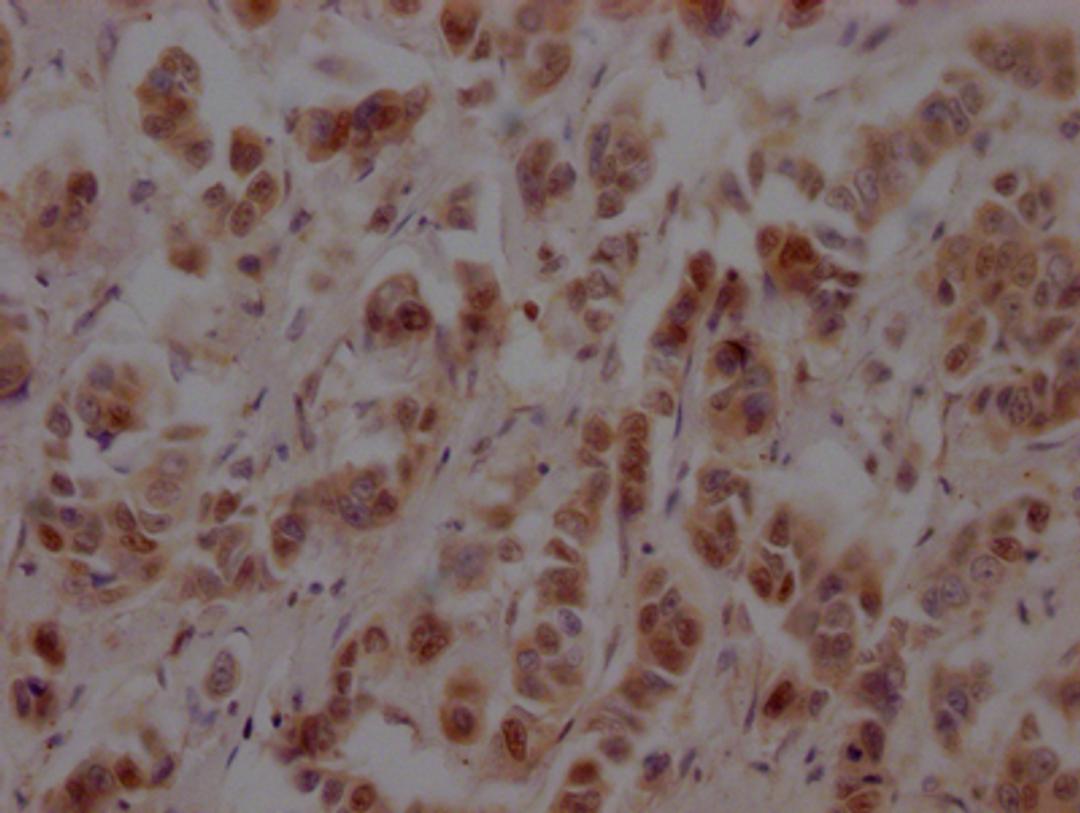 IHC image of CSB-RA986790A0HU diluted at 1:100 and staining in paraffin-embedded human breast cancer performed on a Leica BondTM system. After dewaxing and hydration, antigen retrieval was mediated by high pressure in a citrate buffer (pH 6.0). Section was blocked with 10% normal goat serum 30min at RT. Then primary antibody (1% BSA) was incubated at 4℃ overnight. The primary is detected by a Goat anti-rabbit IgG polymer labeled by HRP and visualized using 0.05% DAB.