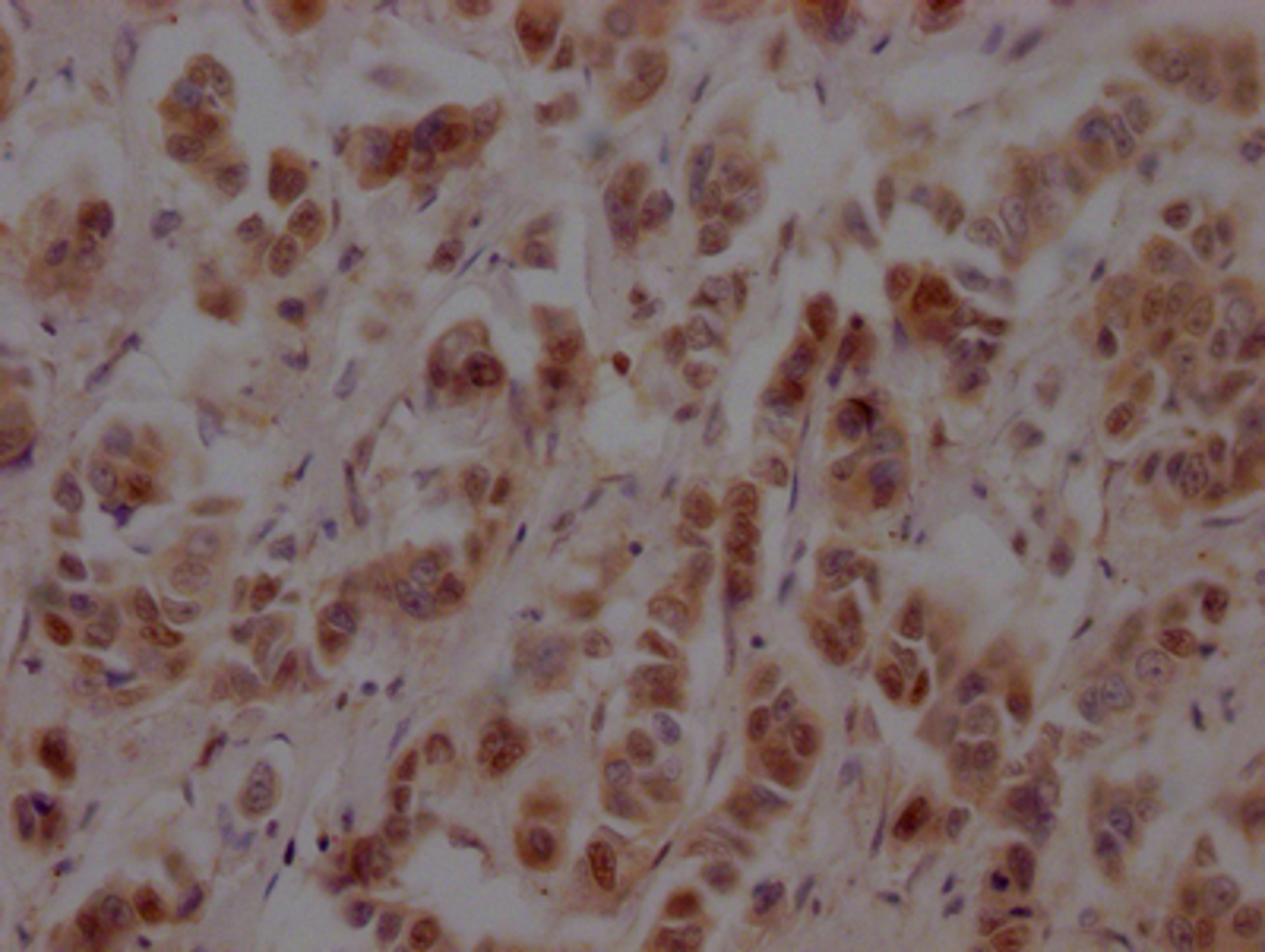 IHC image of CSB-RA986790A0HU diluted at 1:100 and staining in paraffin-embedded human breast cancer performed on a Leica BondTM system. After dewaxing and hydration, antigen retrieval was mediated by high pressure in a citrate buffer (pH 6.0). Section was blocked with 10% normal goat serum 30min at RT. Then primary antibody (1% BSA) was incubated at 4℃ overnight. The primary is detected by a Goat anti-rabbit IgG polymer labeled by HRP and visualized using 0.05% DAB.