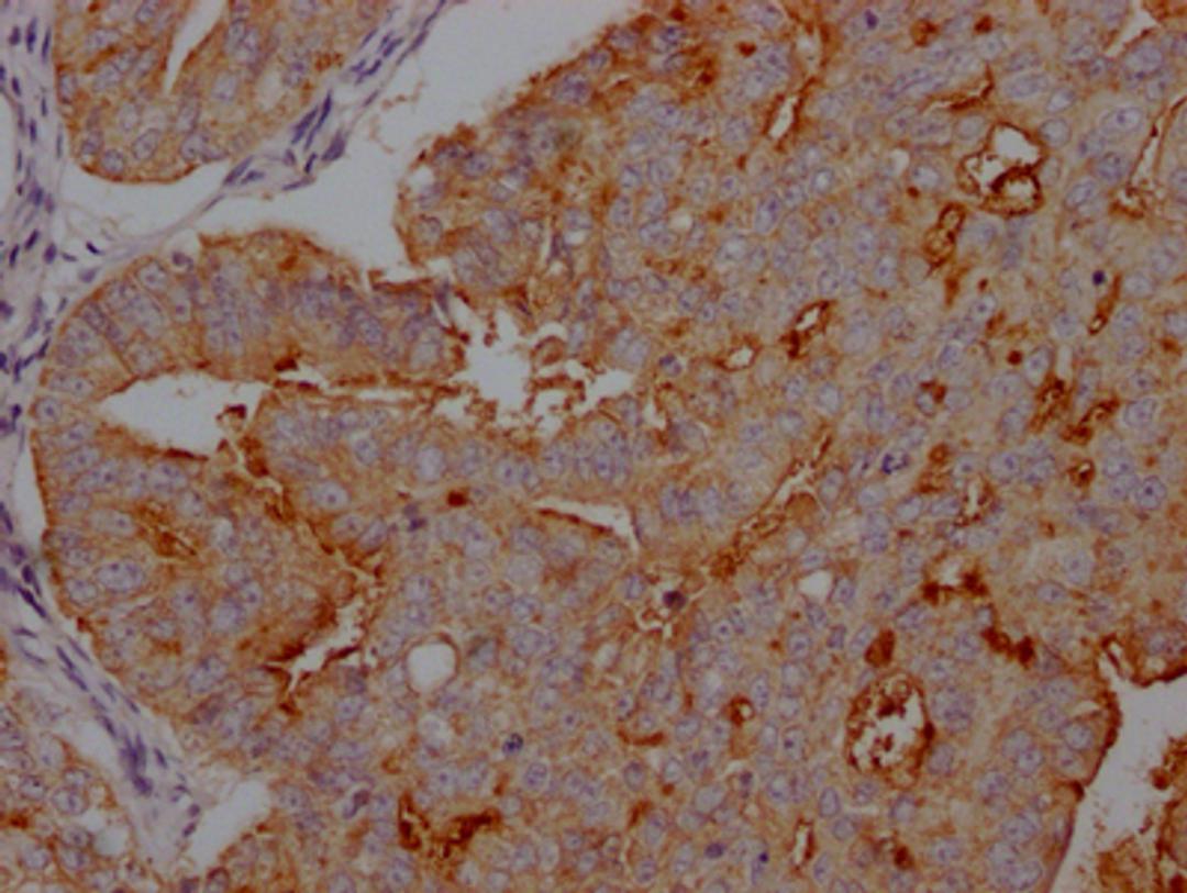 IHC image of CSB-RA941216A0HU diluted at 1:100 and staining in paraffin-embedded human endometrial cancer performed on a Leica BondTM system. After dewaxing and hydration, antigen retrieval was mediated by high pressure in a citrate buffer (pH 6.0). Section was blocked with 10% normal goat serum 30min at RT. Then primary antibody (1% BSA) was incubated at 4℃ overnight. The primary is detected by a Goat anti-rabbit IgG polymer labeled by HRP and visualized using 0.05% DAB.