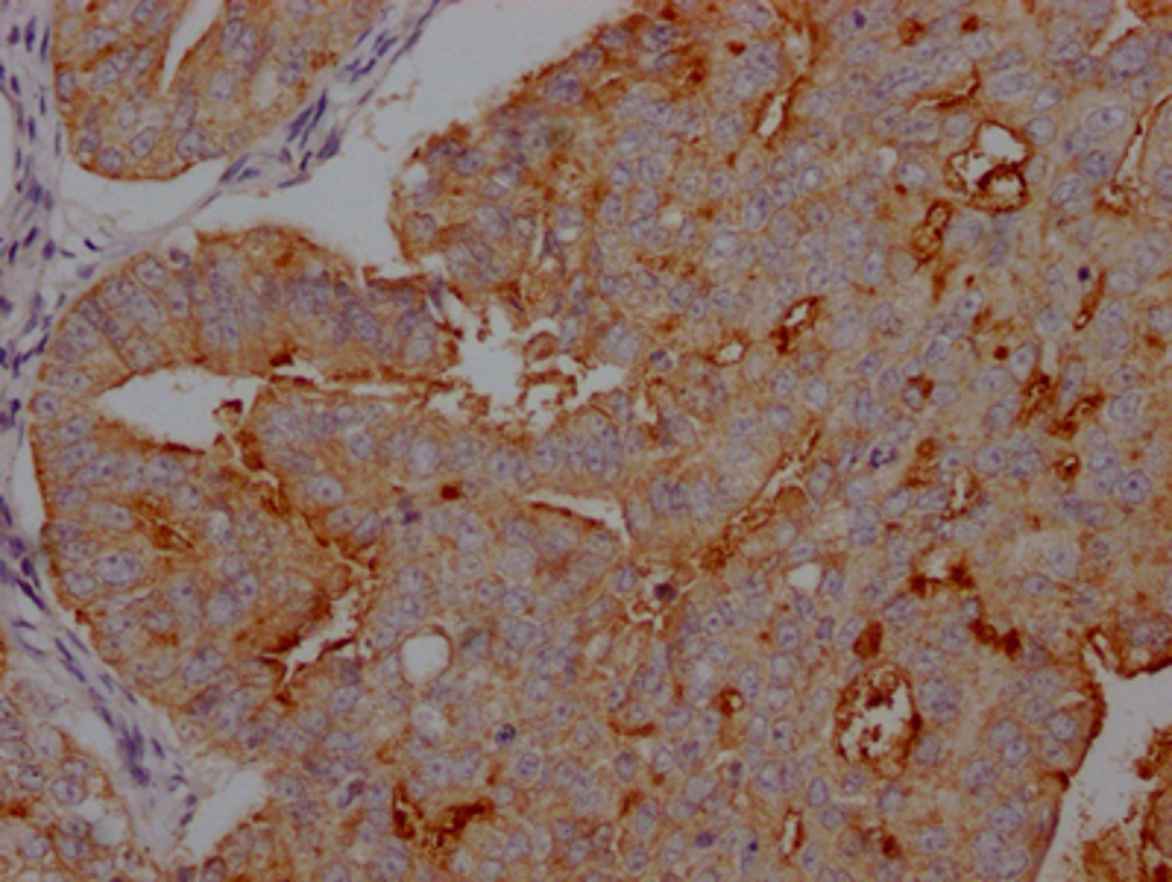 IHC image of CSB-RA941216A0HU diluted at 1:100 and staining in paraffin-embedded human endometrial cancer performed on a Leica BondTM system. After dewaxing and hydration, antigen retrieval was mediated by high pressure in a citrate buffer (pH 6.0). Section was blocked with 10% normal goat serum 30min at RT. Then primary antibody (1% BSA) was incubated at 4℃ overnight. The primary is detected by a Goat anti-rabbit IgG polymer labeled by HRP and visualized using 0.05% DAB.