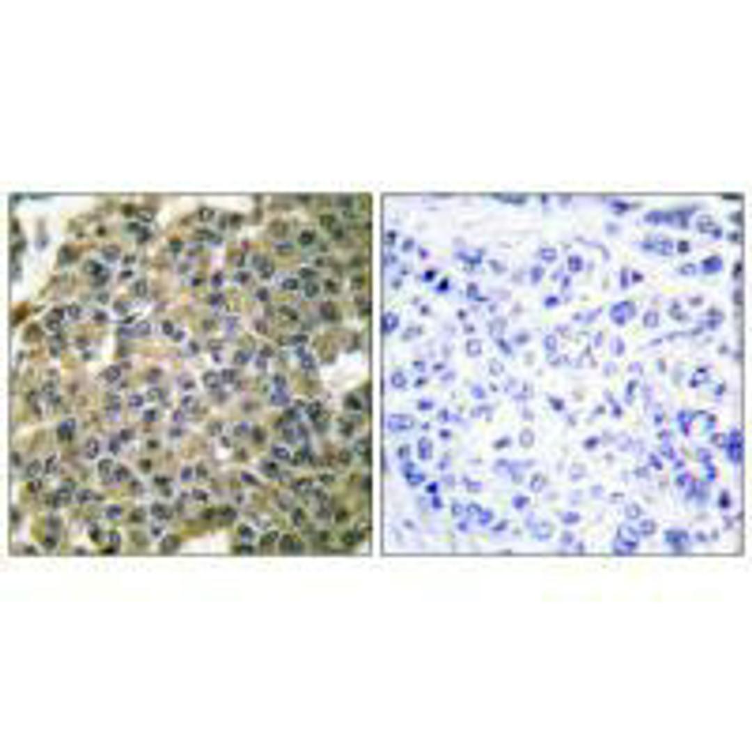 Immunohistochemical analysis of paraffin-embedded human breast carcinoma tissue using Keratin 7 antibody.