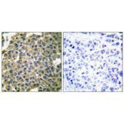Immunohistochemical analysis of paraffin-embedded human breast carcinoma tissue using Keratin 7 antibody.
