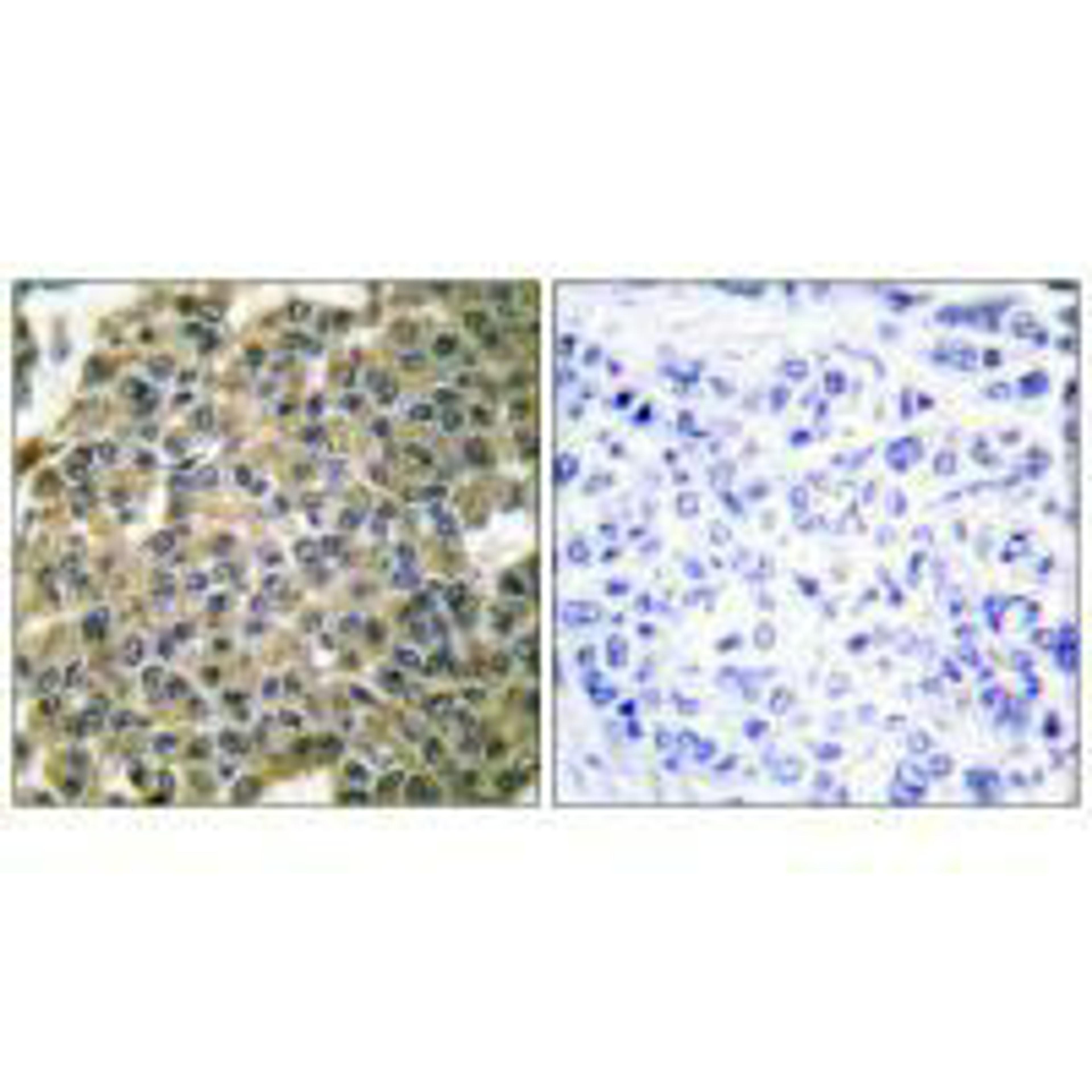 Immunohistochemical analysis of paraffin-embedded human breast carcinoma tissue using Keratin 7 antibody.