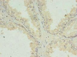 Immunohistochemistry of paraffin-embedded human prostate cancer using CSB-PA13669A0Rb at dilution of 1:100