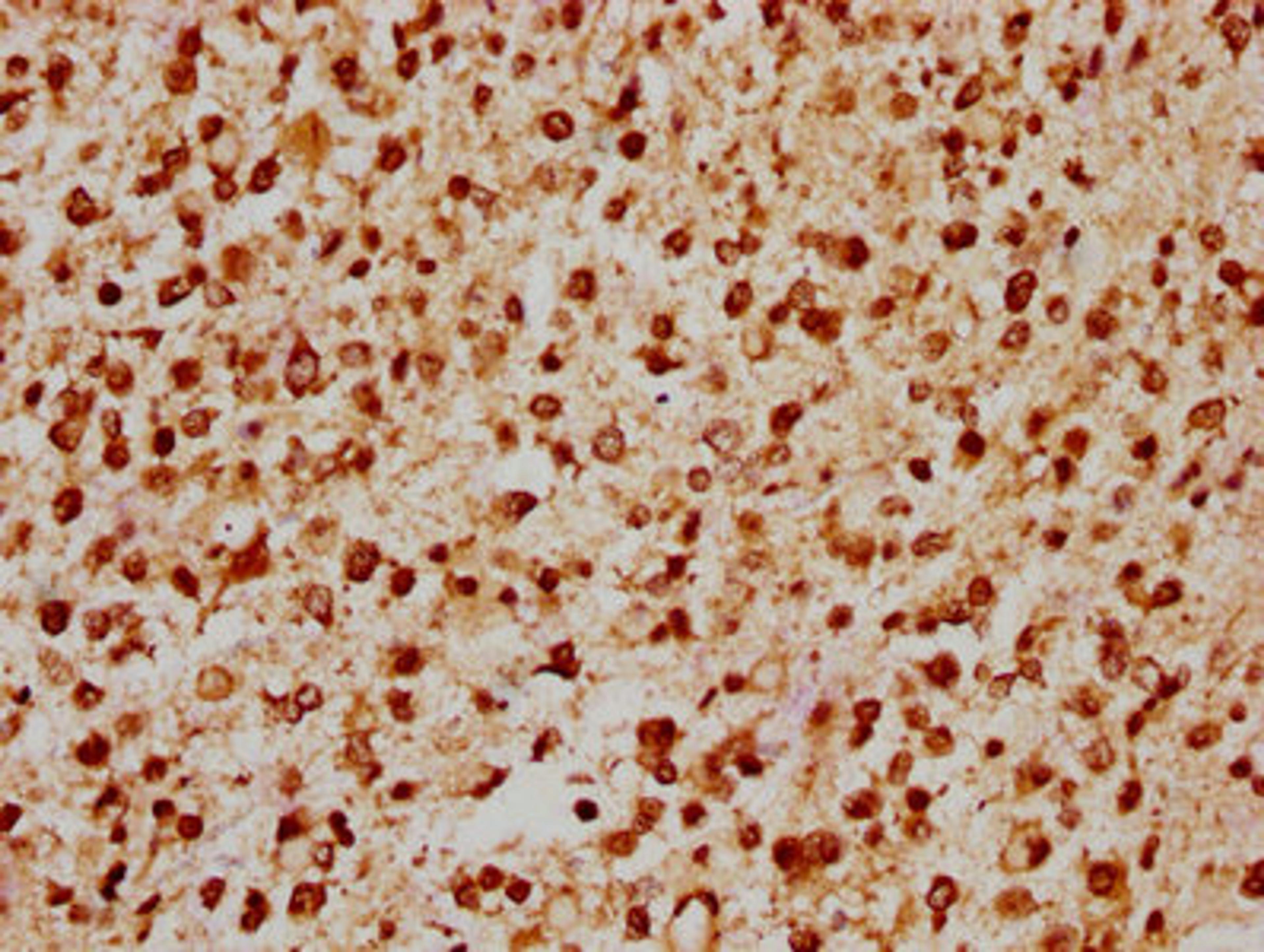 IHC image of CSB-PA22769A0Rb diluted at 1:200 and staining in paraffin-embedded human glioma performed on a Leica BondTM system. After dewaxing and hydration, antigen retrieval was mediated by high pressure in a citrate buffer (pH 6.0). Section was blocked with 10% normal goat serum 30min at RT. Then primary antibody (1% BSA) was incubated at 4°C overnight. The primary is detected by a biotinylated secondary antibody and visualized using an HRP conjugated SP system.