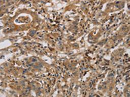 The image is immunohistochemistry of paraffin-embedded Human gastric cancer tissue using CSB-PA785649(CASP9 Antibody) at dilution 1/70. (Original magnification: ×200)