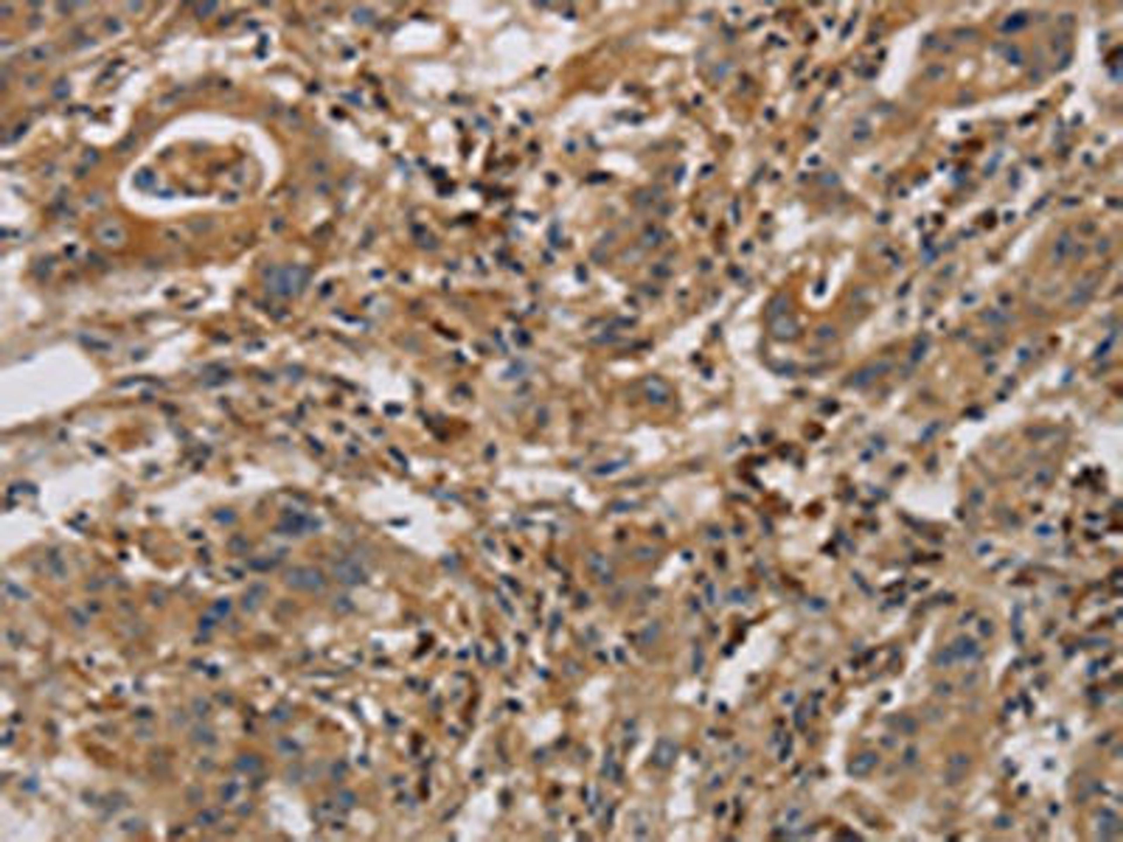 The image is immunohistochemistry of paraffin-embedded Human gastric cancer tissue using CSB-PA785649(CASP9 Antibody) at dilution 1/70. (Original magnification: ×200)