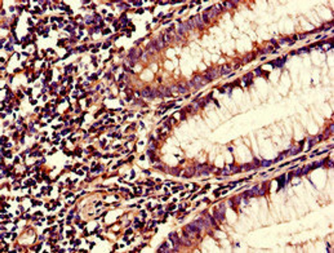 Immunohistochemistry of paraffin-embedded human colon cancer using CSB-PA020623LA01HU at dilution of 1:100