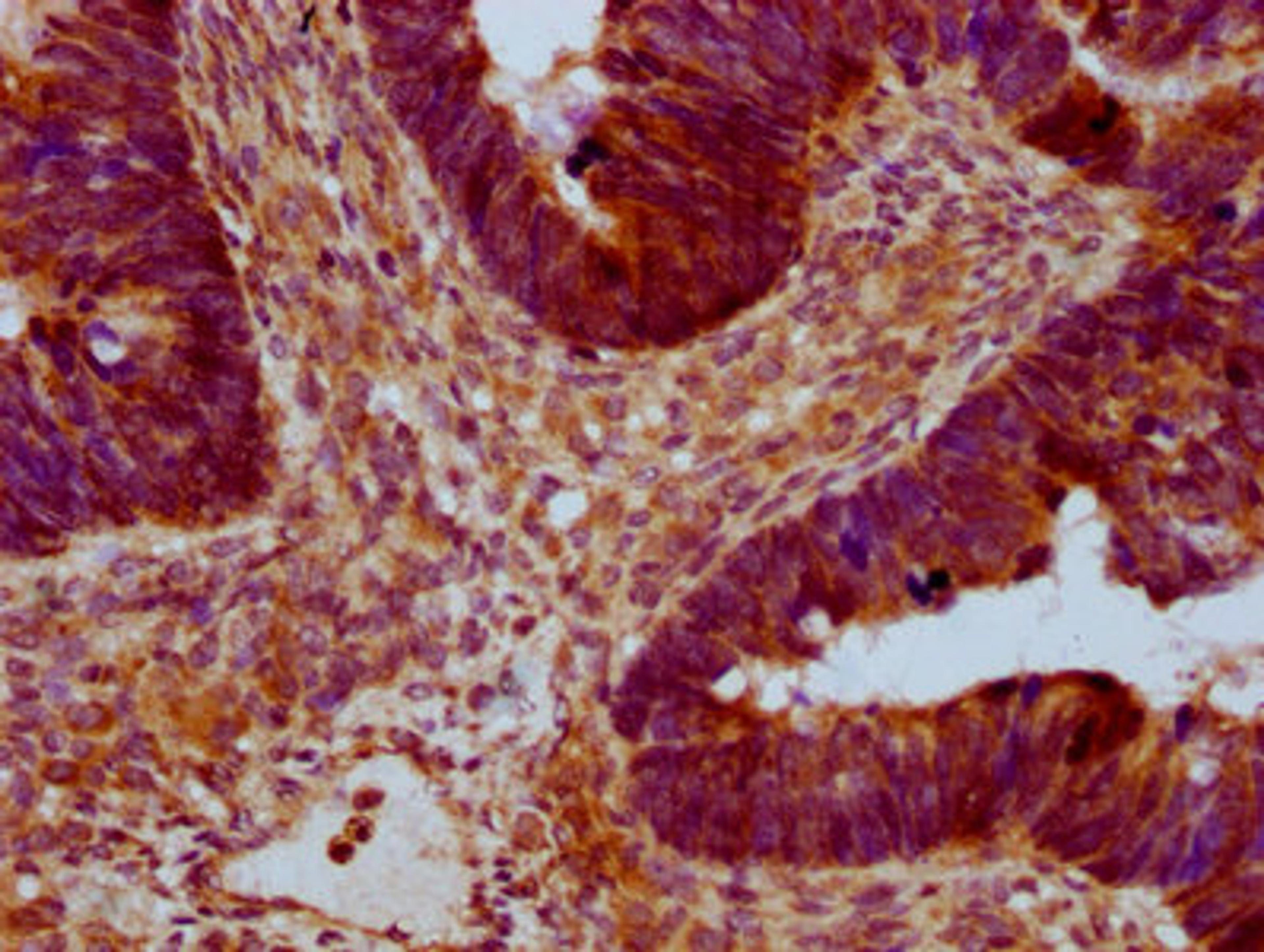 IHC image of CSB-PA891733LA01HU diluted at 1:400 and staining in paraffin-embedded human ovarian cancer performed on a Leica BondTM system. After dewaxing and hydration, antigen retrieval was mediated by high pressure in a citrate buffer (pH 6.0). Section was blocked with 10% normal goat serum 30min at RT. Then primary antibody (1% BSA) was incubated at 4°C overnight. The primary is detected by a biotinylated secondary antibody and visualized using an HRP conjugated SP system.