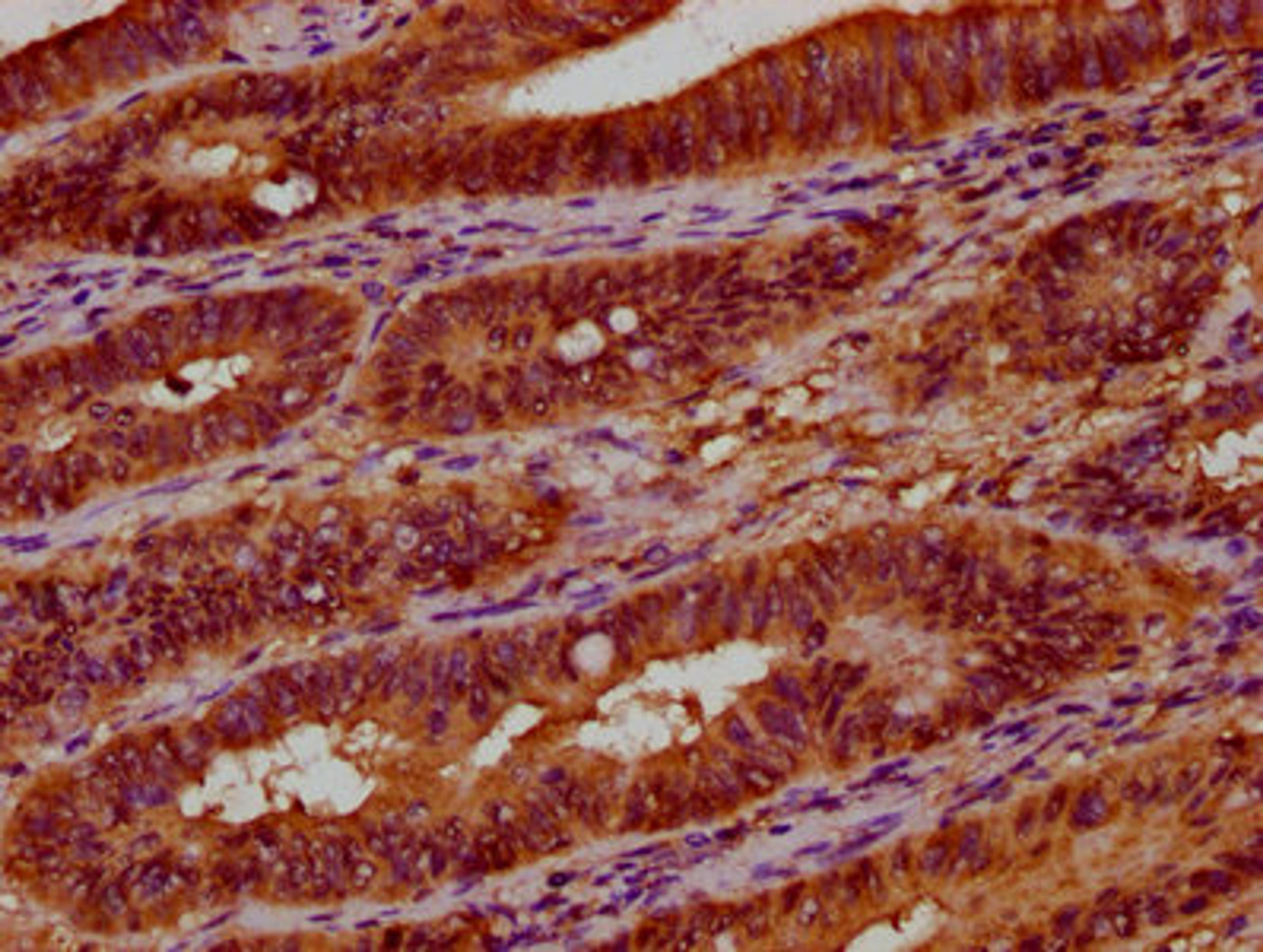 IHC image of CSB-PA025598LA01HU diluted at 1:300 and staining in paraffin-embedded human colon cancer performed on a Leica BondTM system. After dewaxing and hydration, antigen retrieval was mediated by high pressure in a citrate buffer (pH 6.0). Section was blocked with 10% normal goat serum 30min at RT. Then primary antibody (1% BSA) was incubated at 4&deg;C overnight. The primary is detected by a biotinylated secondary antibody and visualized using an HRP conjugated SP system.
