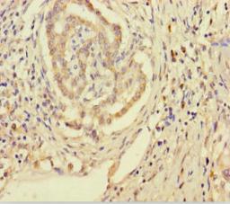 Immunohistochemistry of paraffin-embedded human pancreatic cancer using CSB-PA878920LA01HU at dilution of 1:100