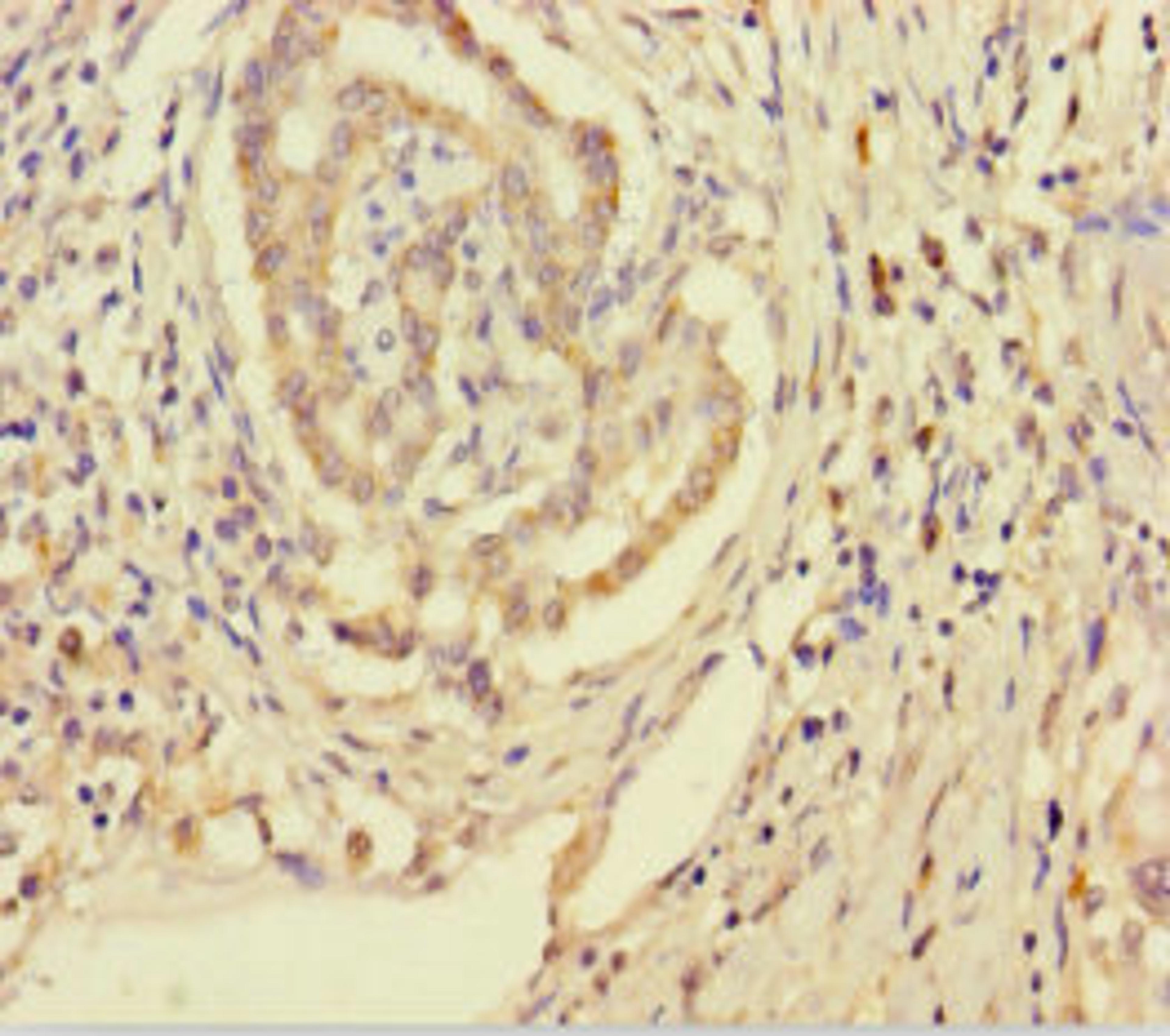 Immunohistochemistry of paraffin-embedded human pancreatic cancer using CSB-PA878920LA01HU at dilution of 1:100