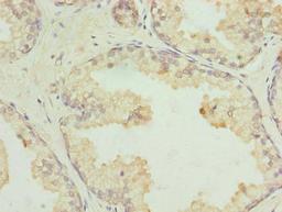 Immunohistochemistry of paraffin-embedded human prostate cancer using CSB-PA860348LA01HU at dilution of 1:100