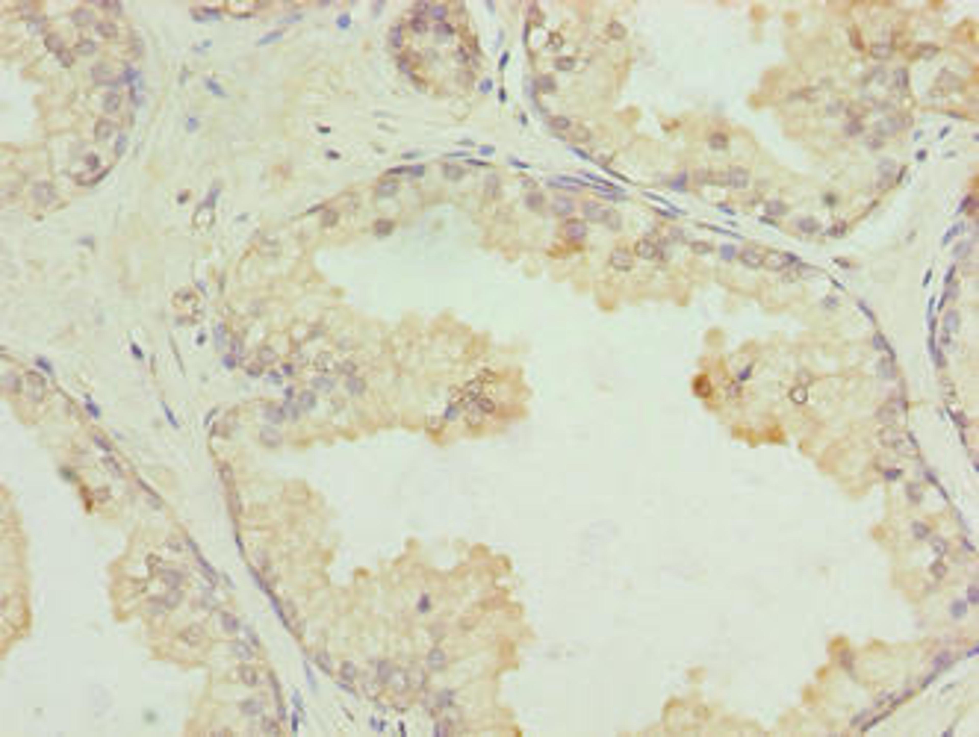 Immunohistochemistry of paraffin-embedded human prostate cancer using CSB-PA860348LA01HU at dilution of 1:100
